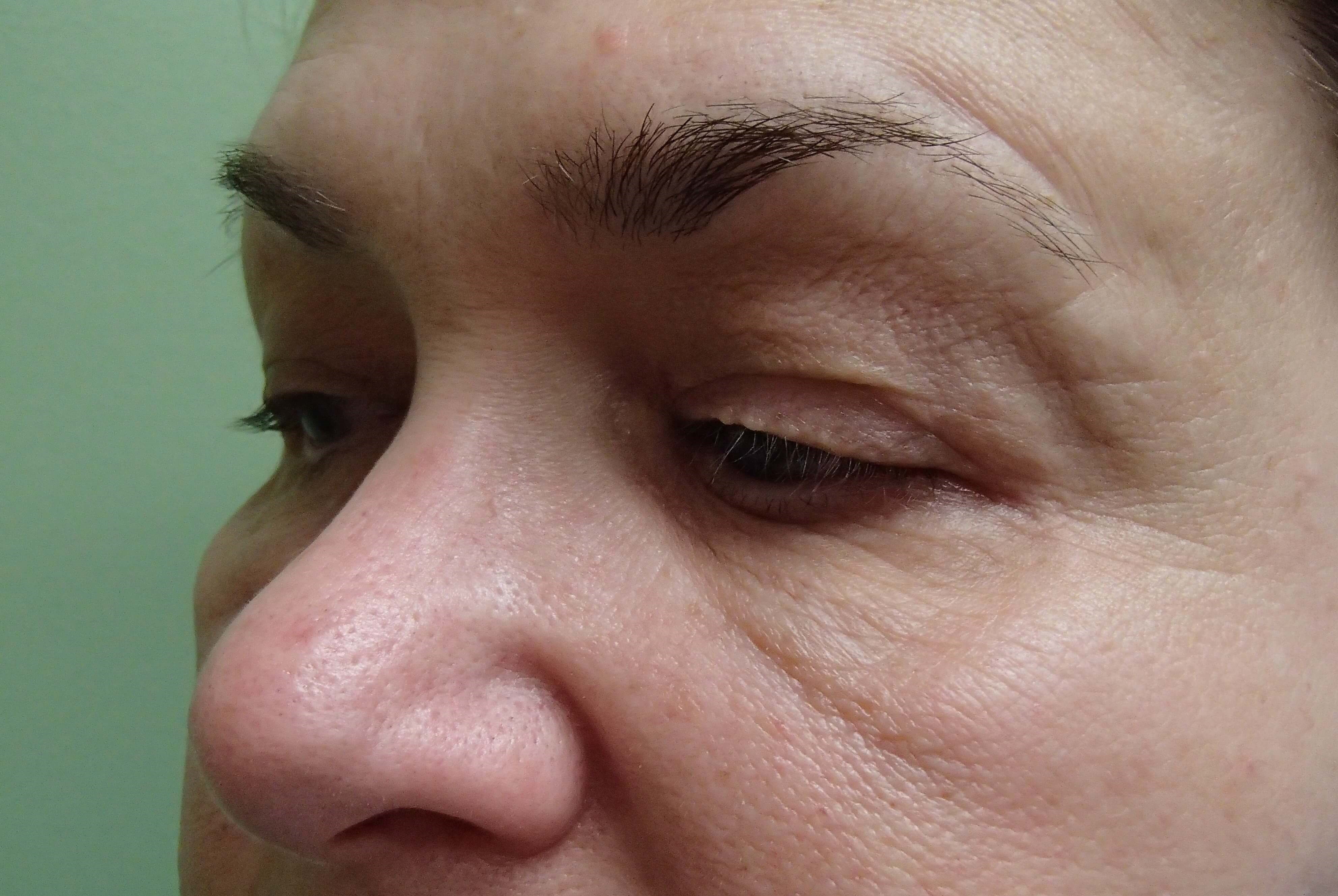 Blepharoplasty Before