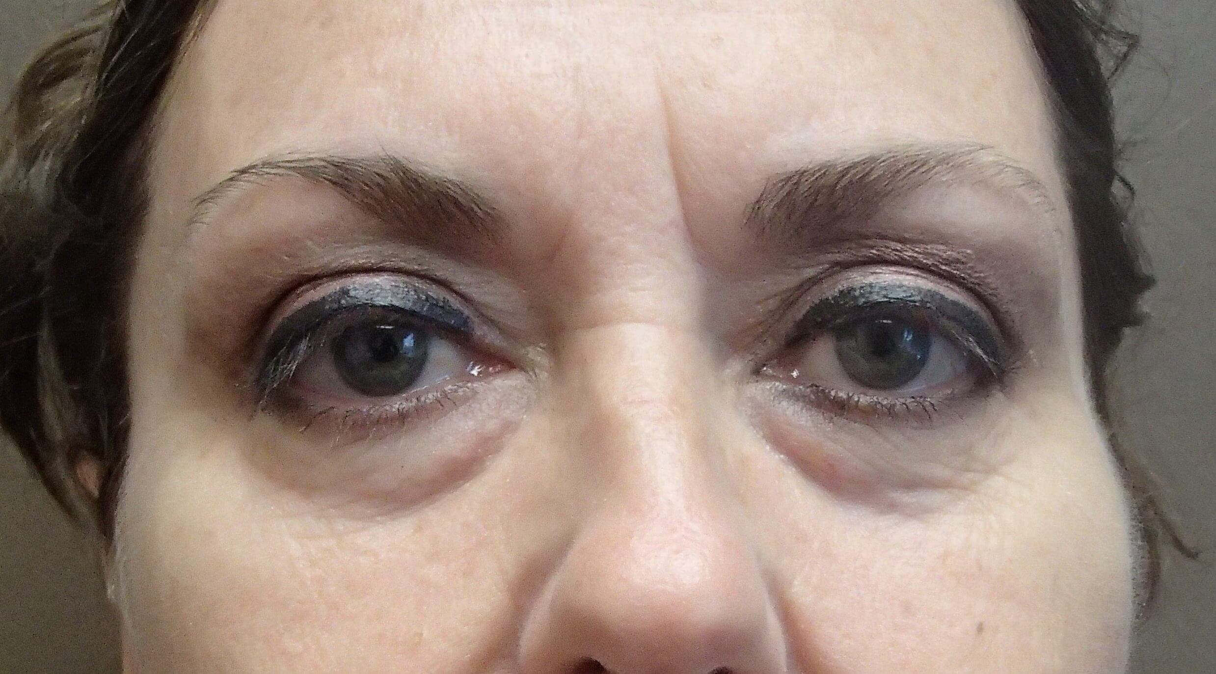 Blepharoplasty Before