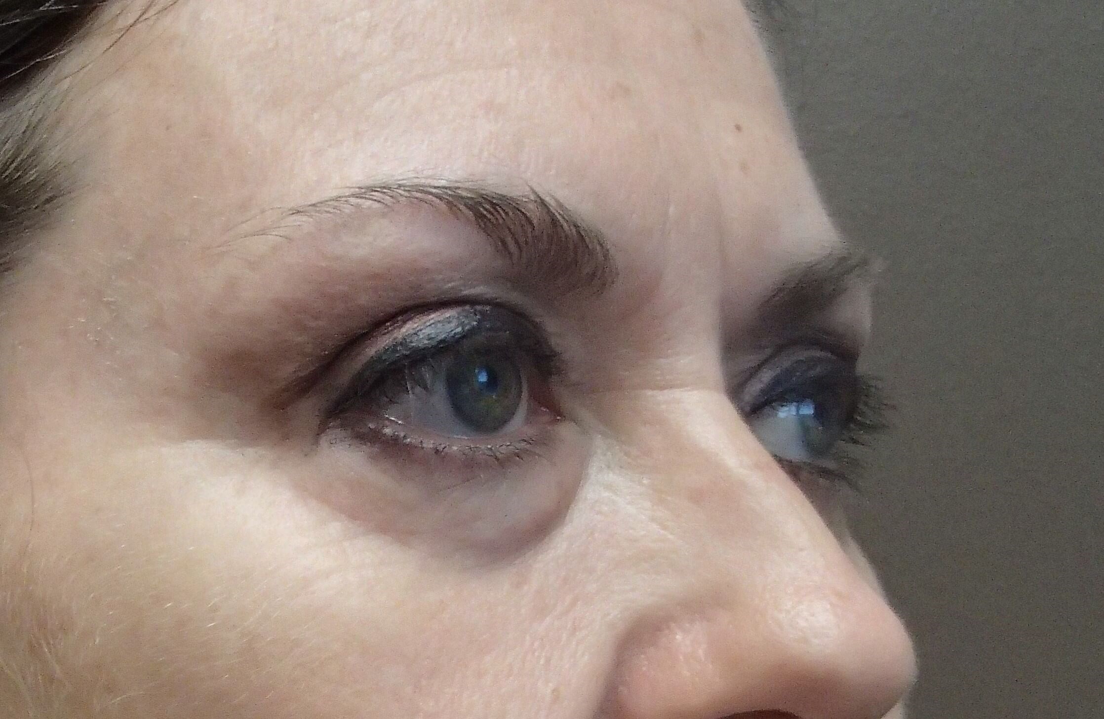 Blepharoplasty Before