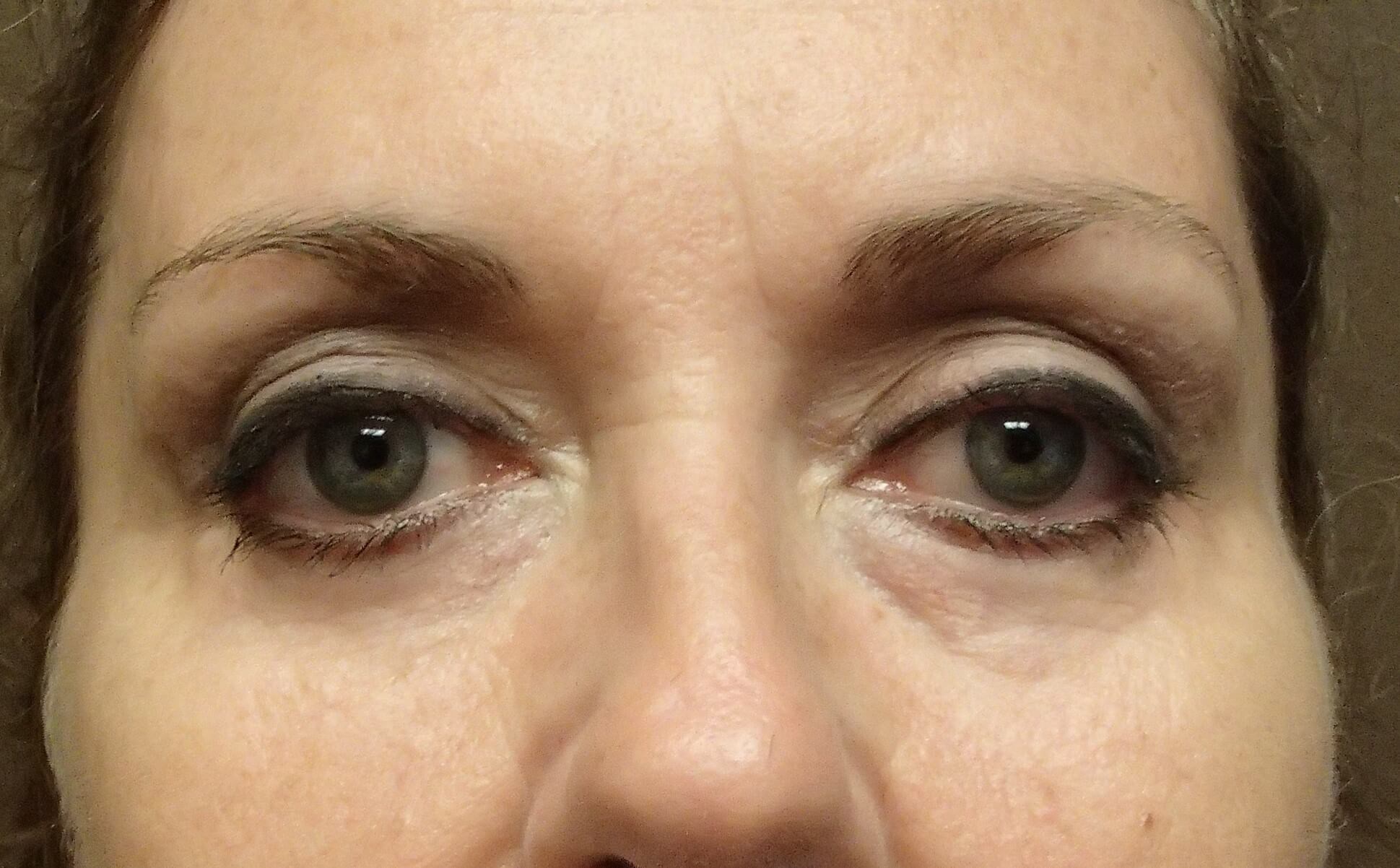 Blepharoplasty After
