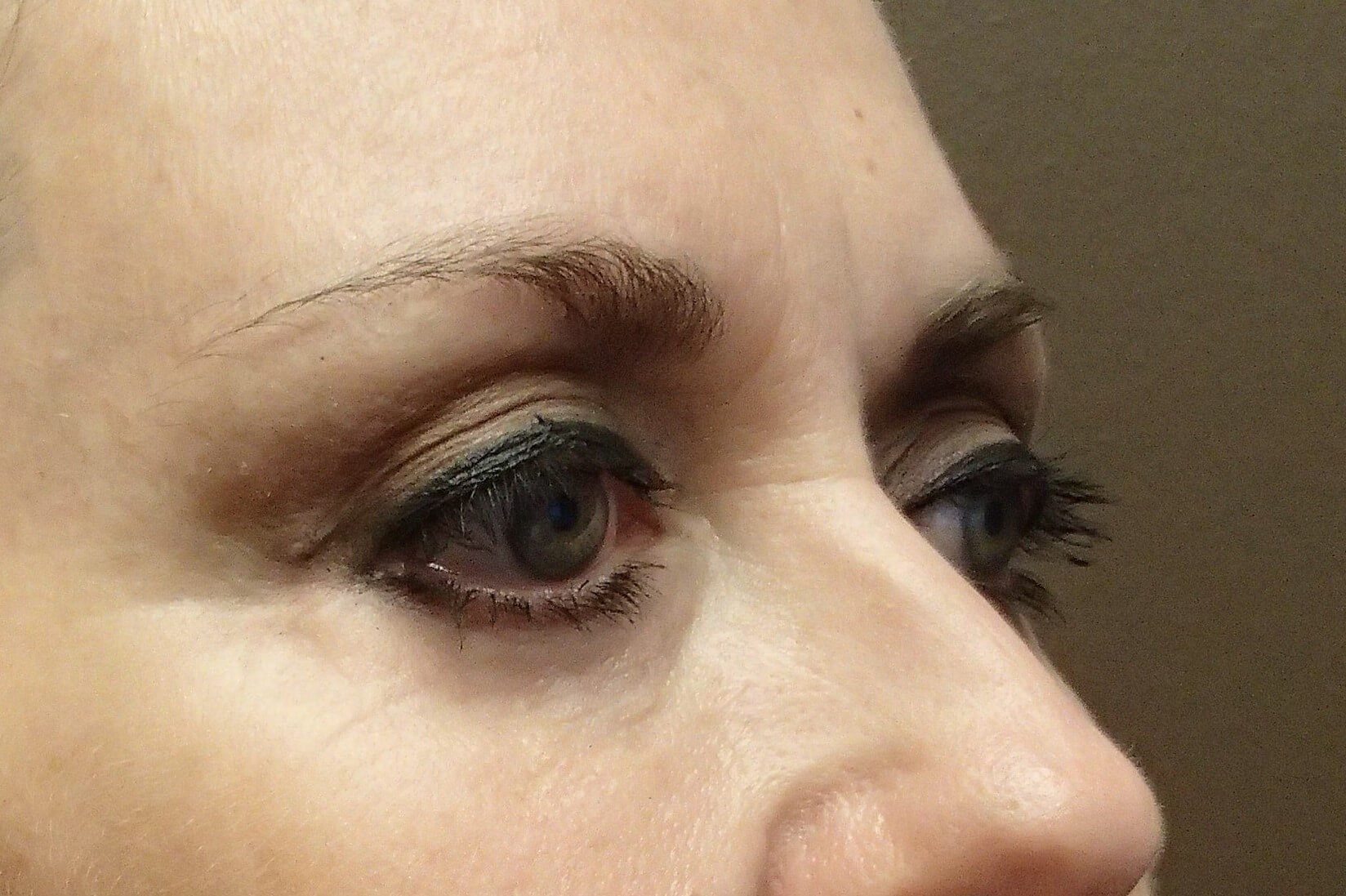 Blepharoplasty After