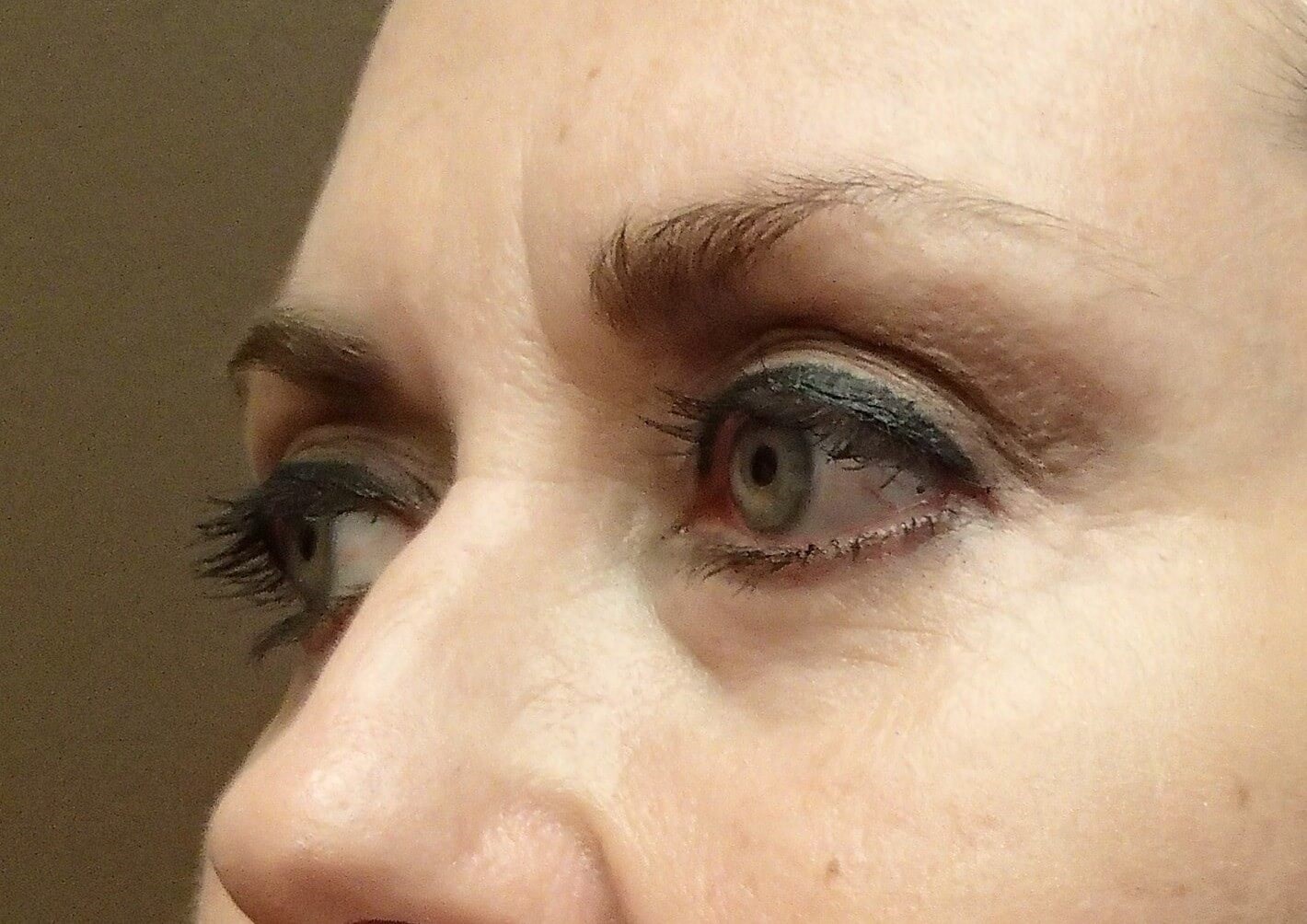Blepharoplasty After