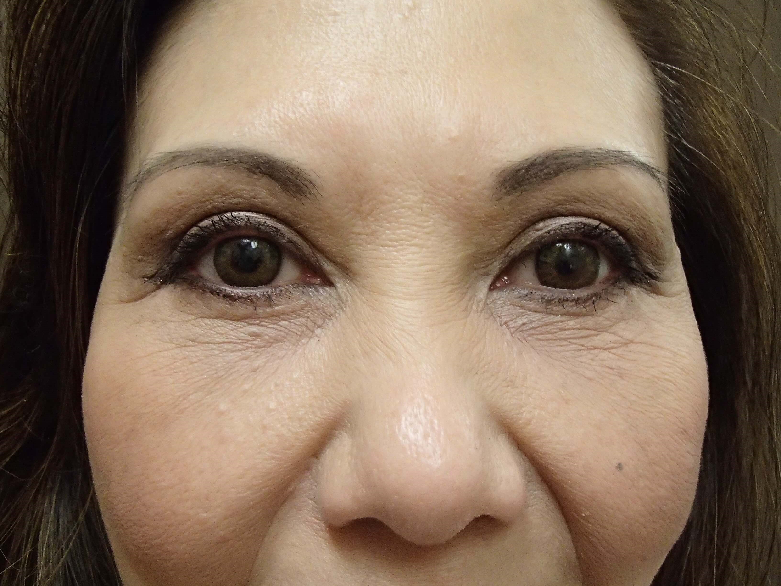 Blepharoplasty After