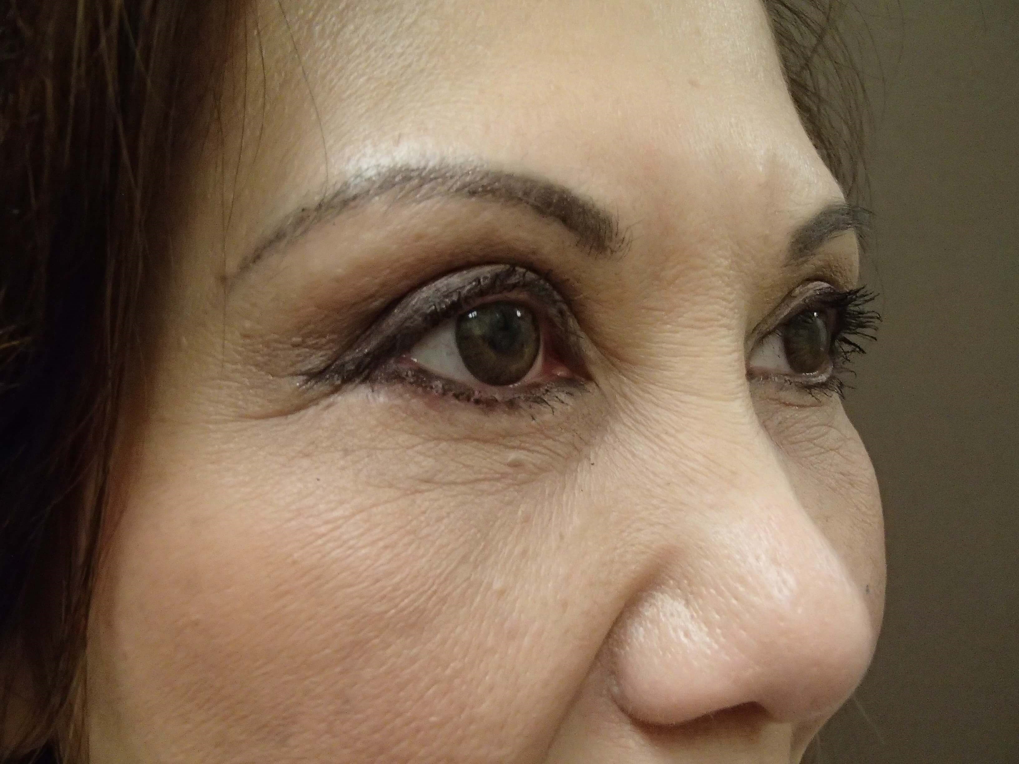 Blepharoplasty After