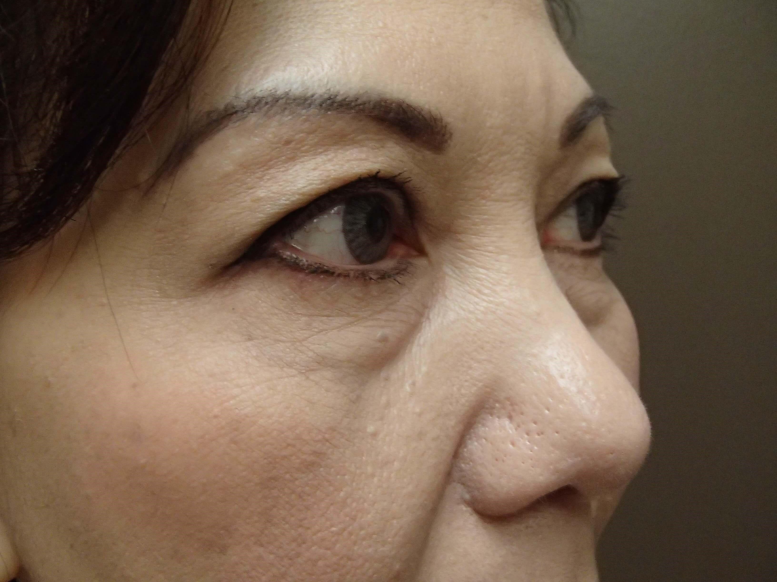 Blepharoplasty Before