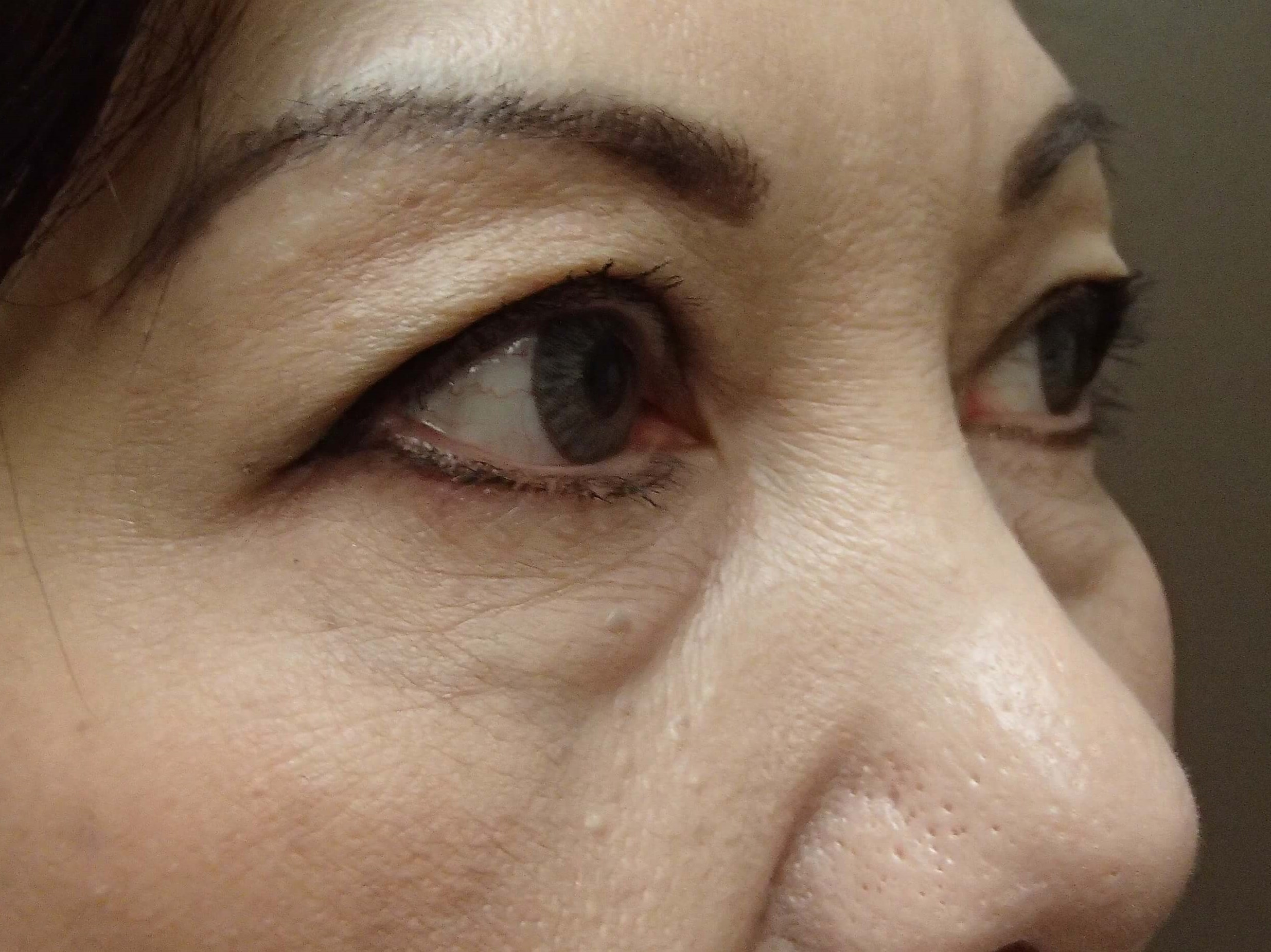 Blepharoplasty Before