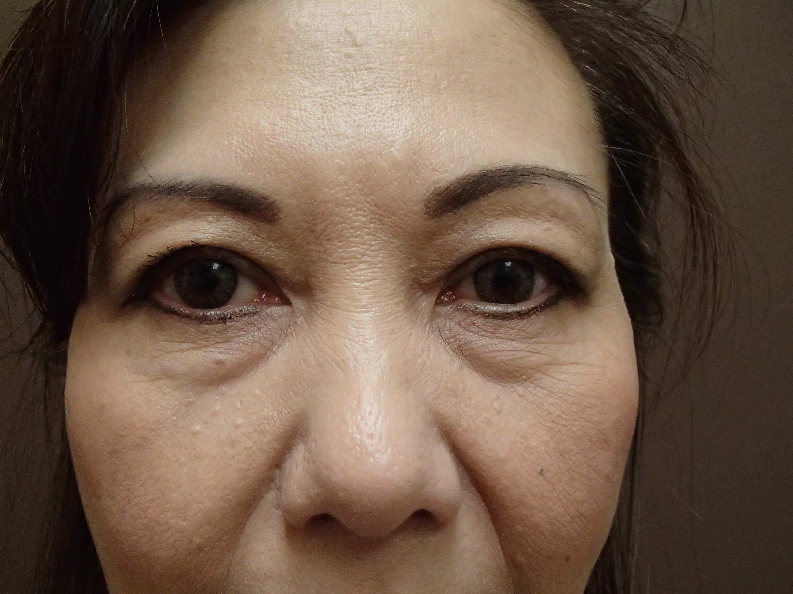 Blepharoplasty Before