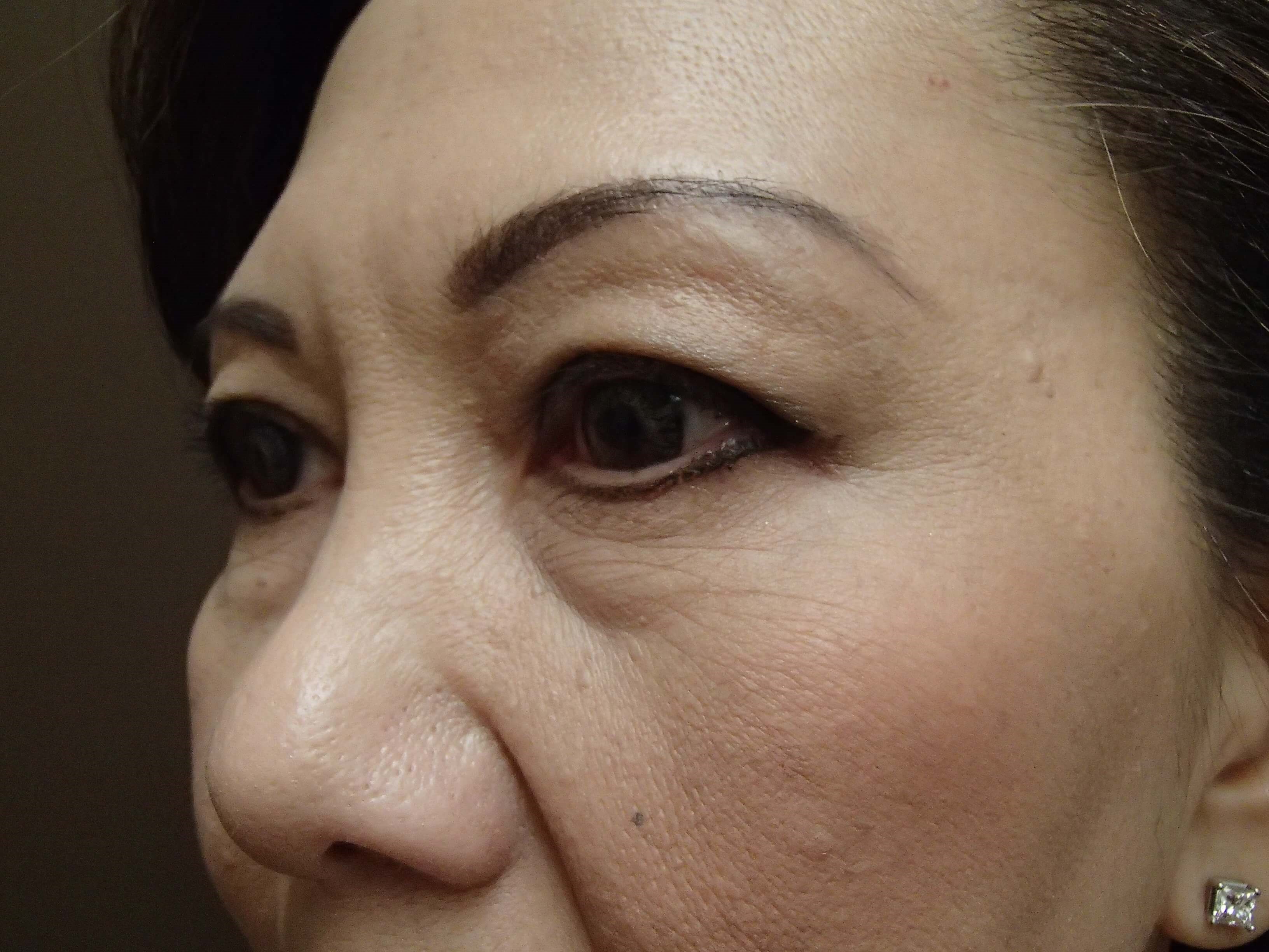 Blepharoplasty Before