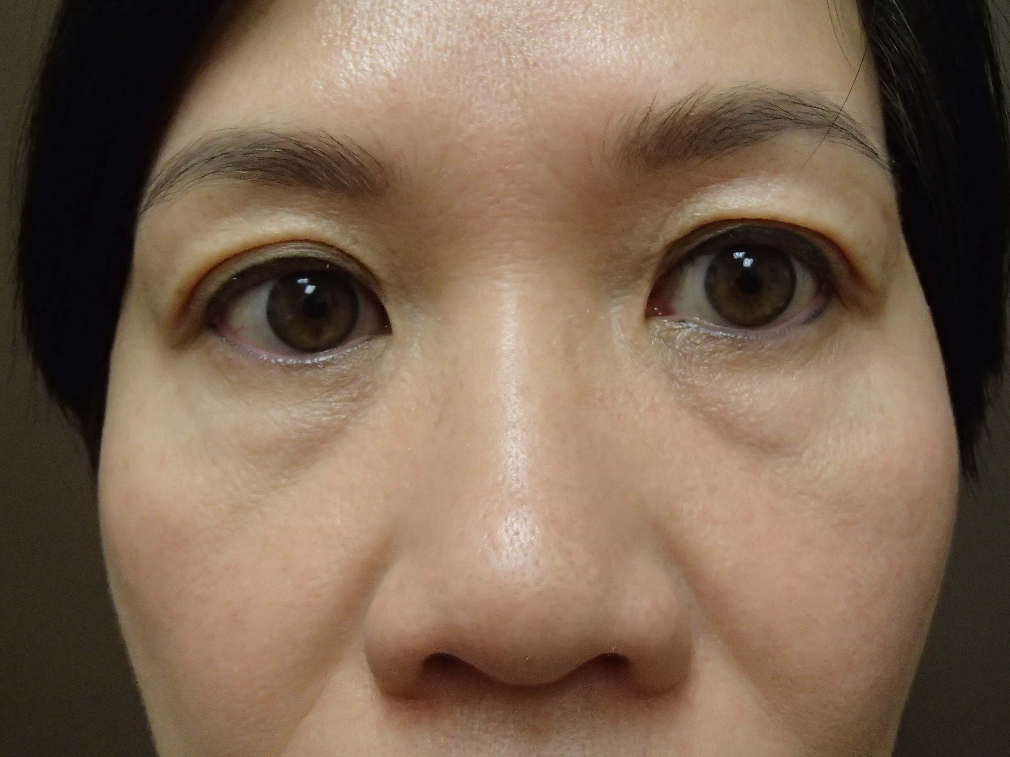 Blepharoplasty Before