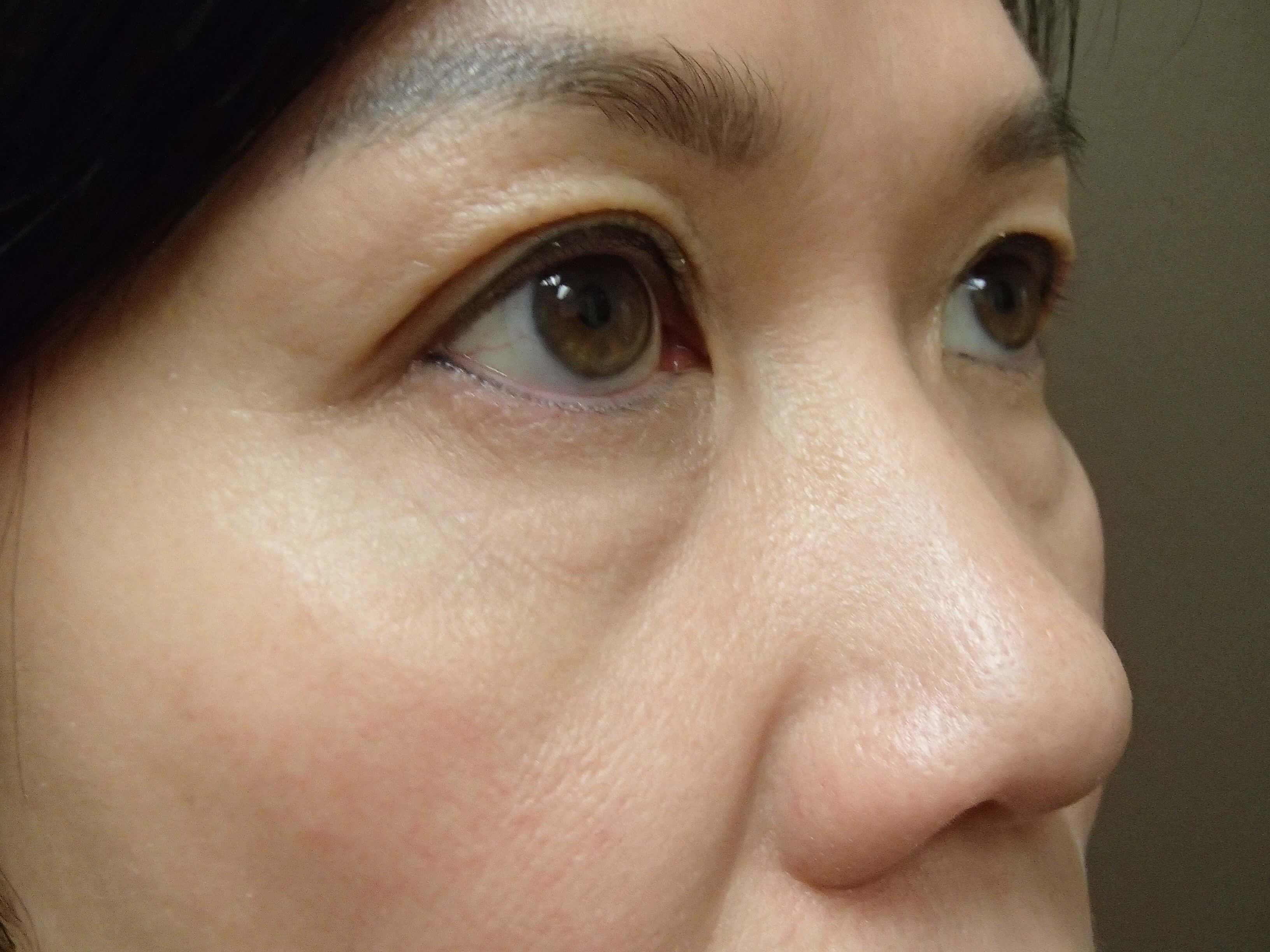 Blepharoplasty Before