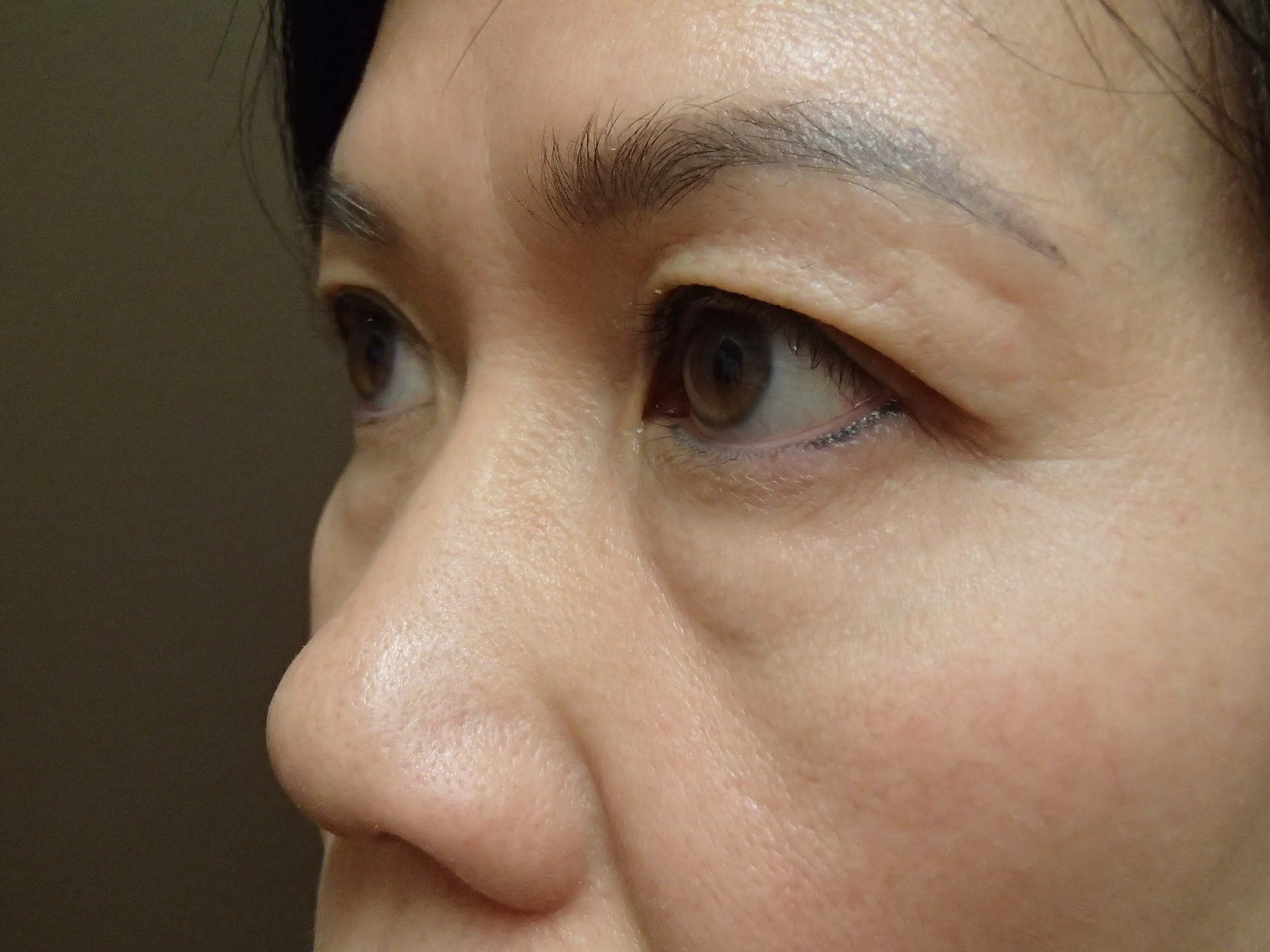 Blepharoplasty Before