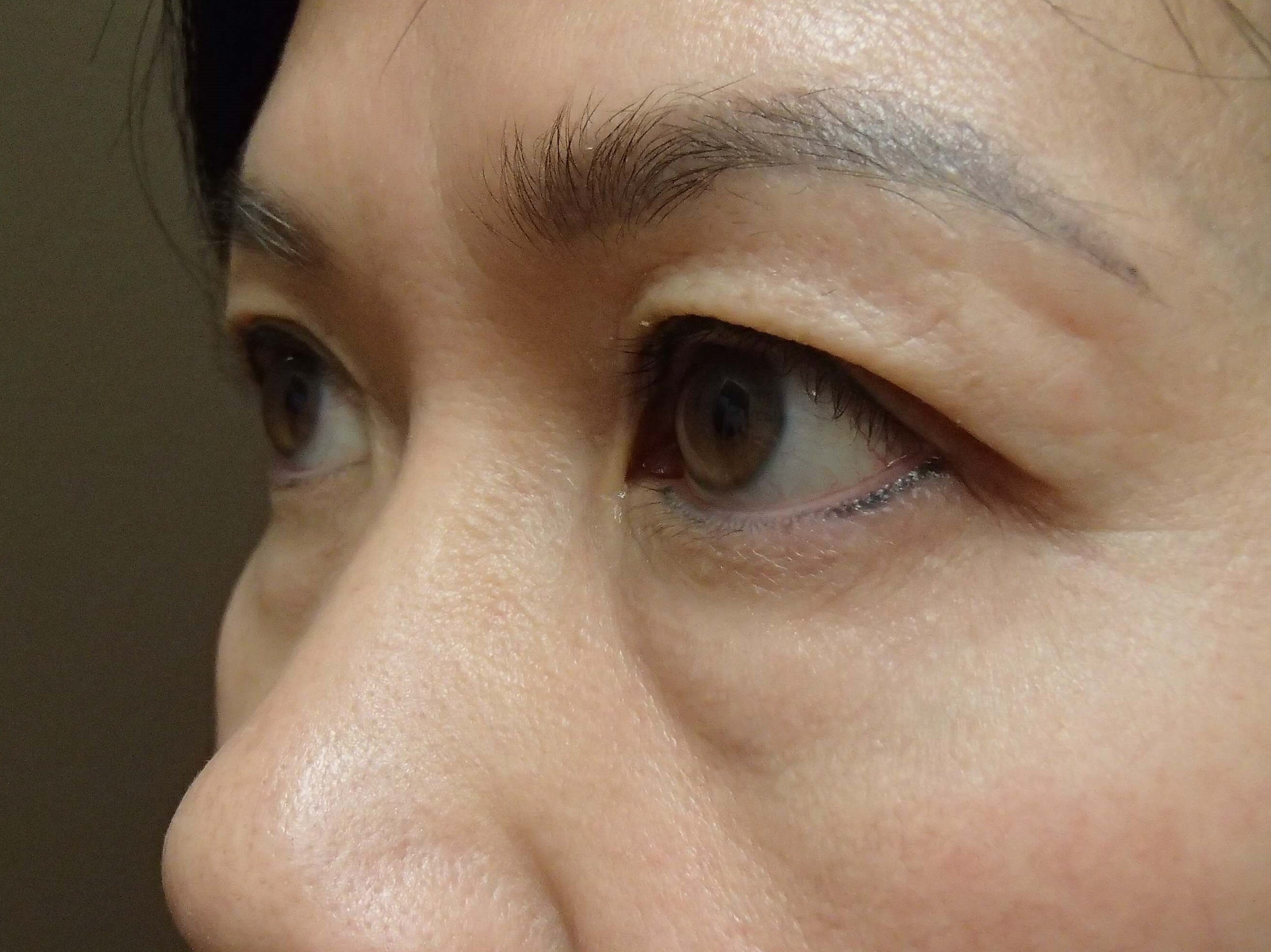 Blepharoplasty Before