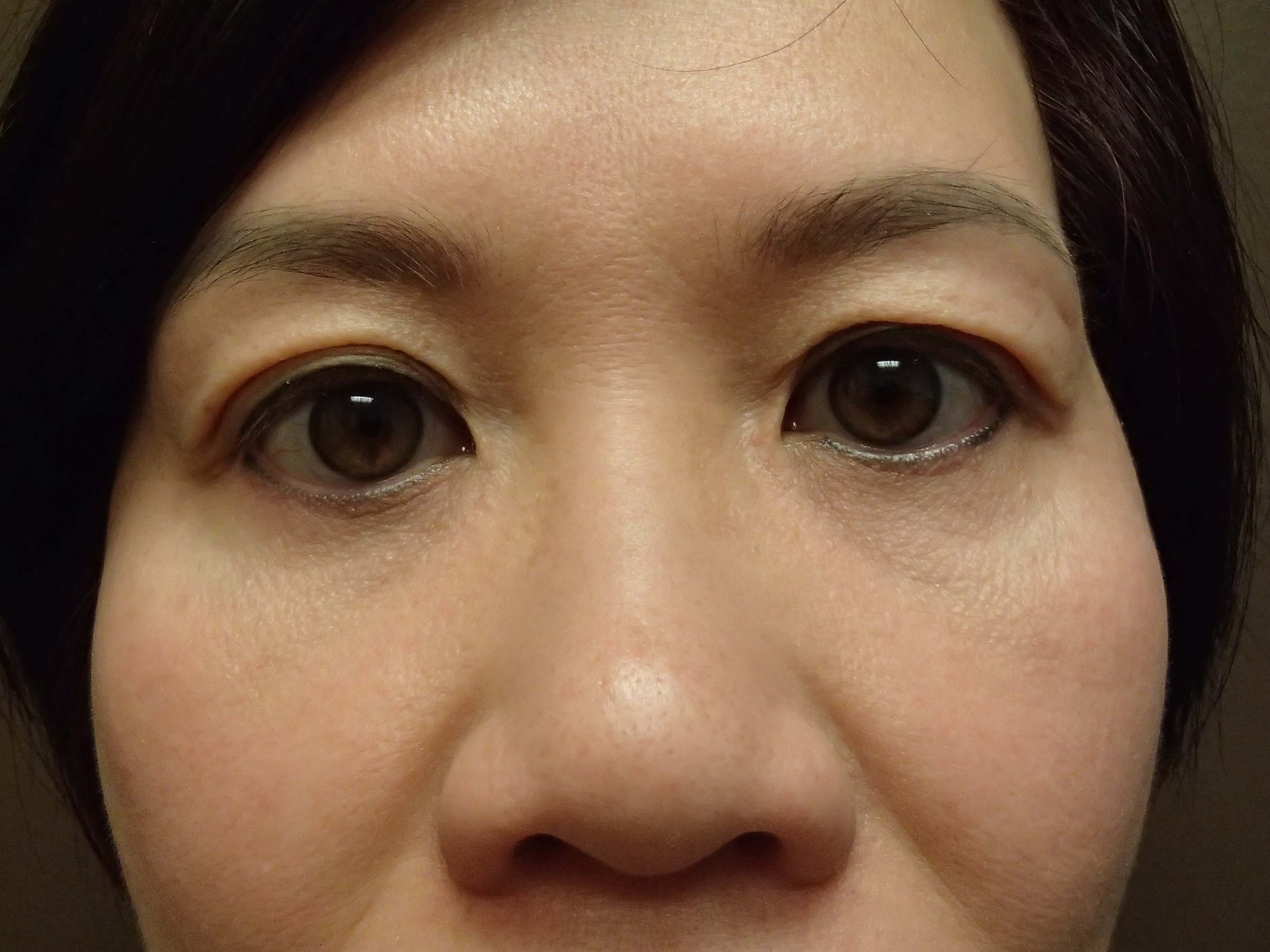 Blepharoplasty After