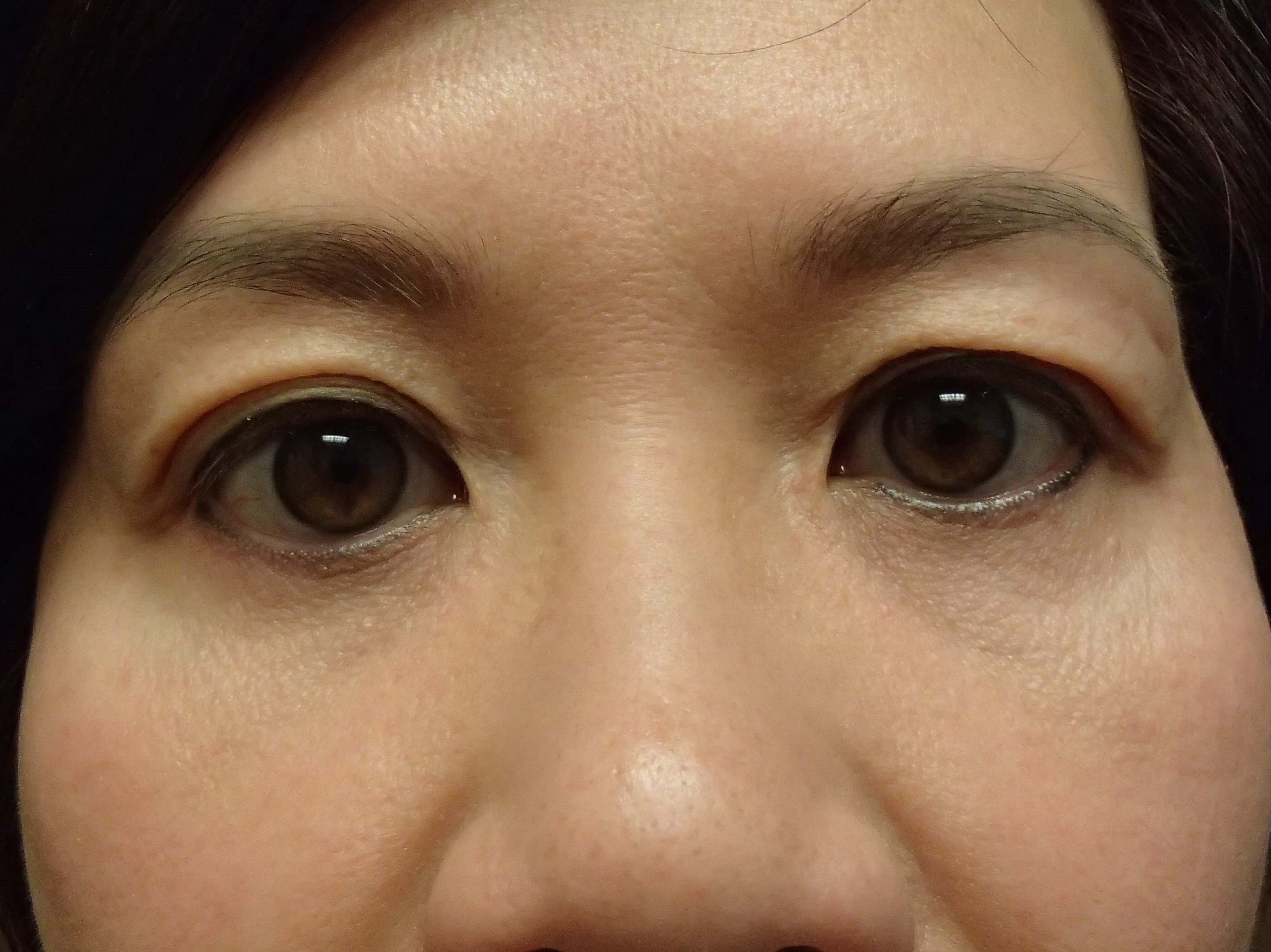Blepharoplasty After
