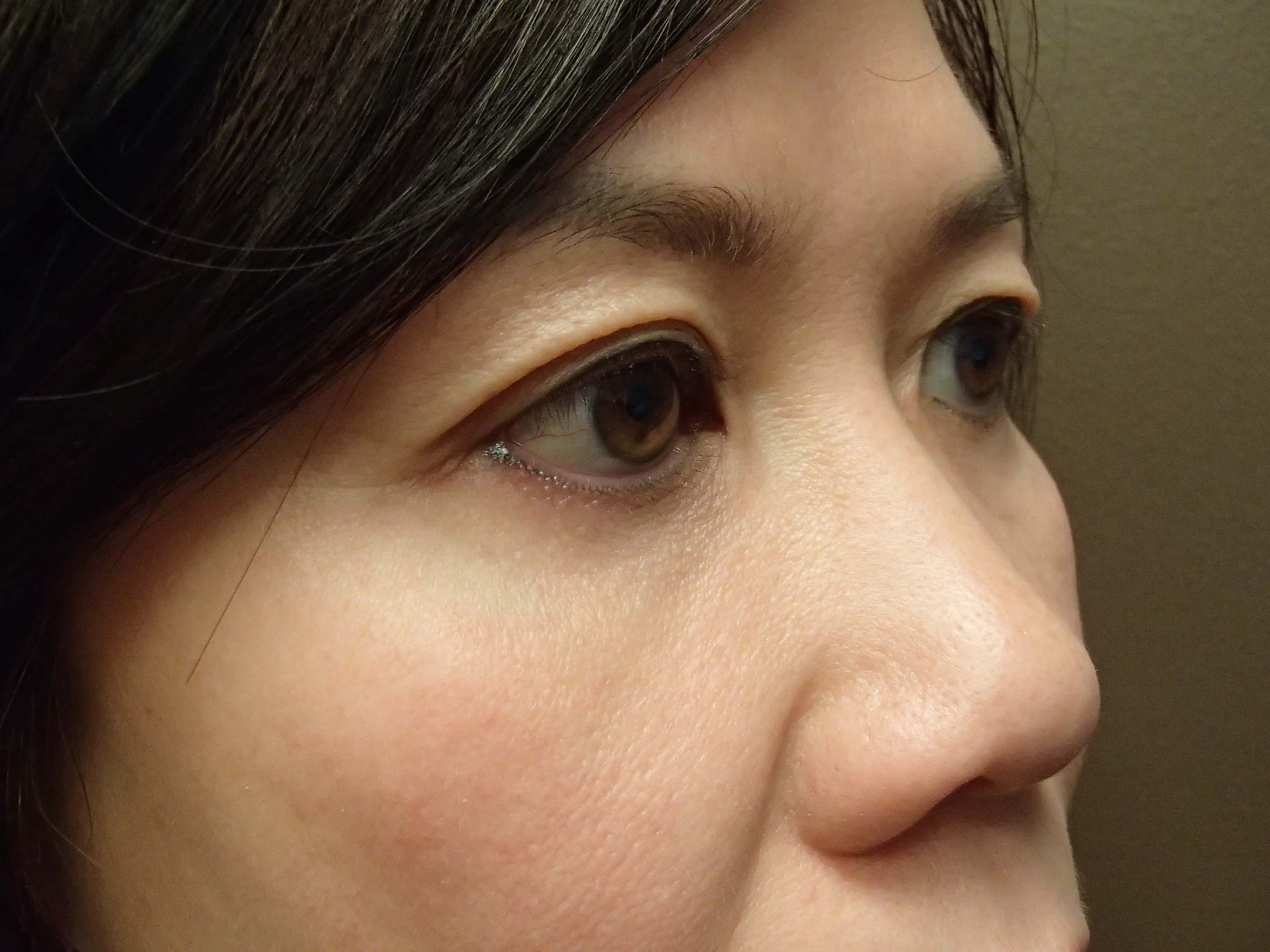 Blepharoplasty After
