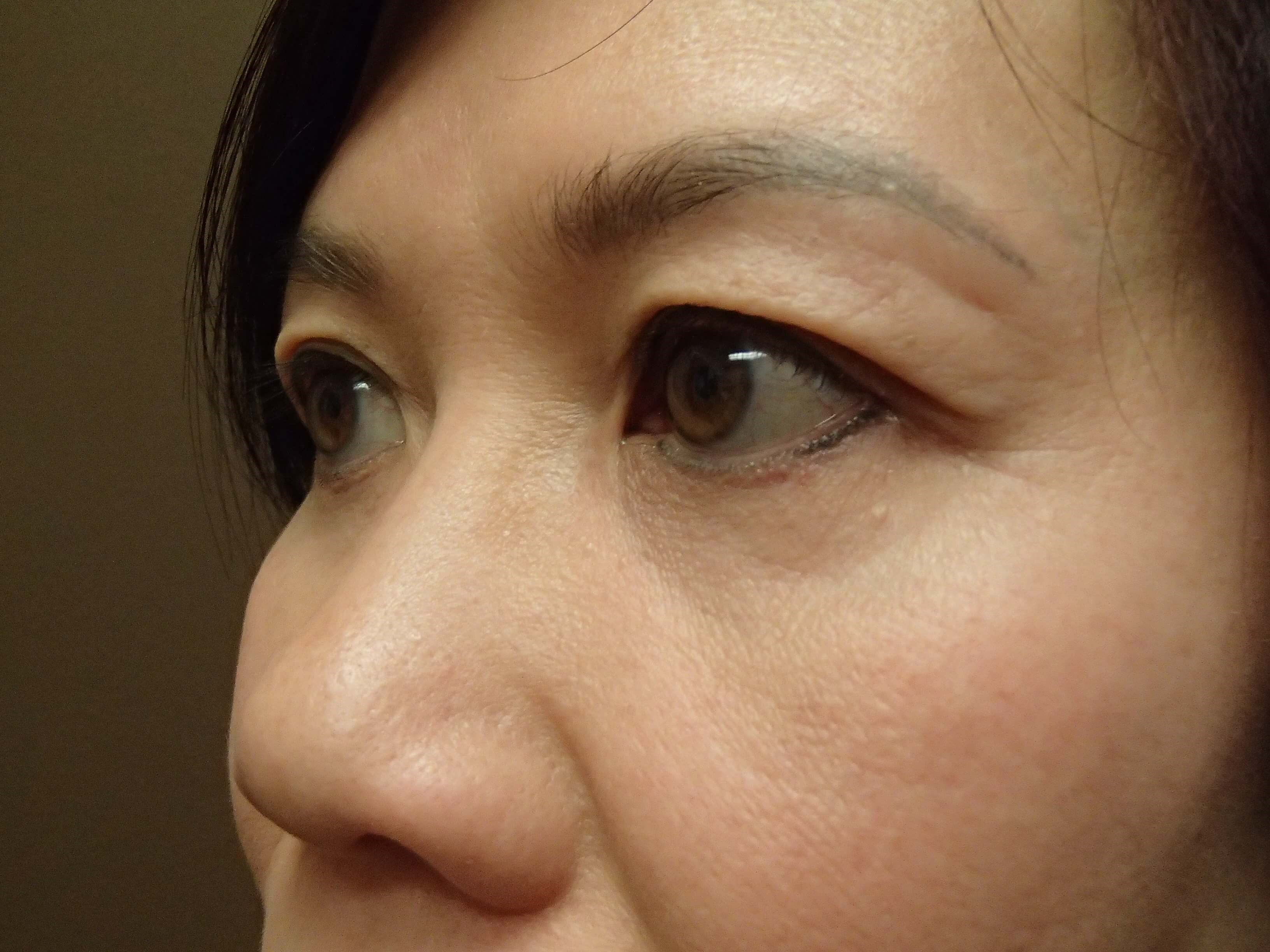 Blepharoplasty After