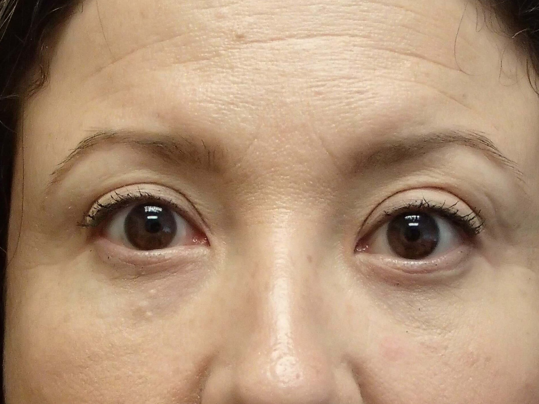 Blepharoplasty After