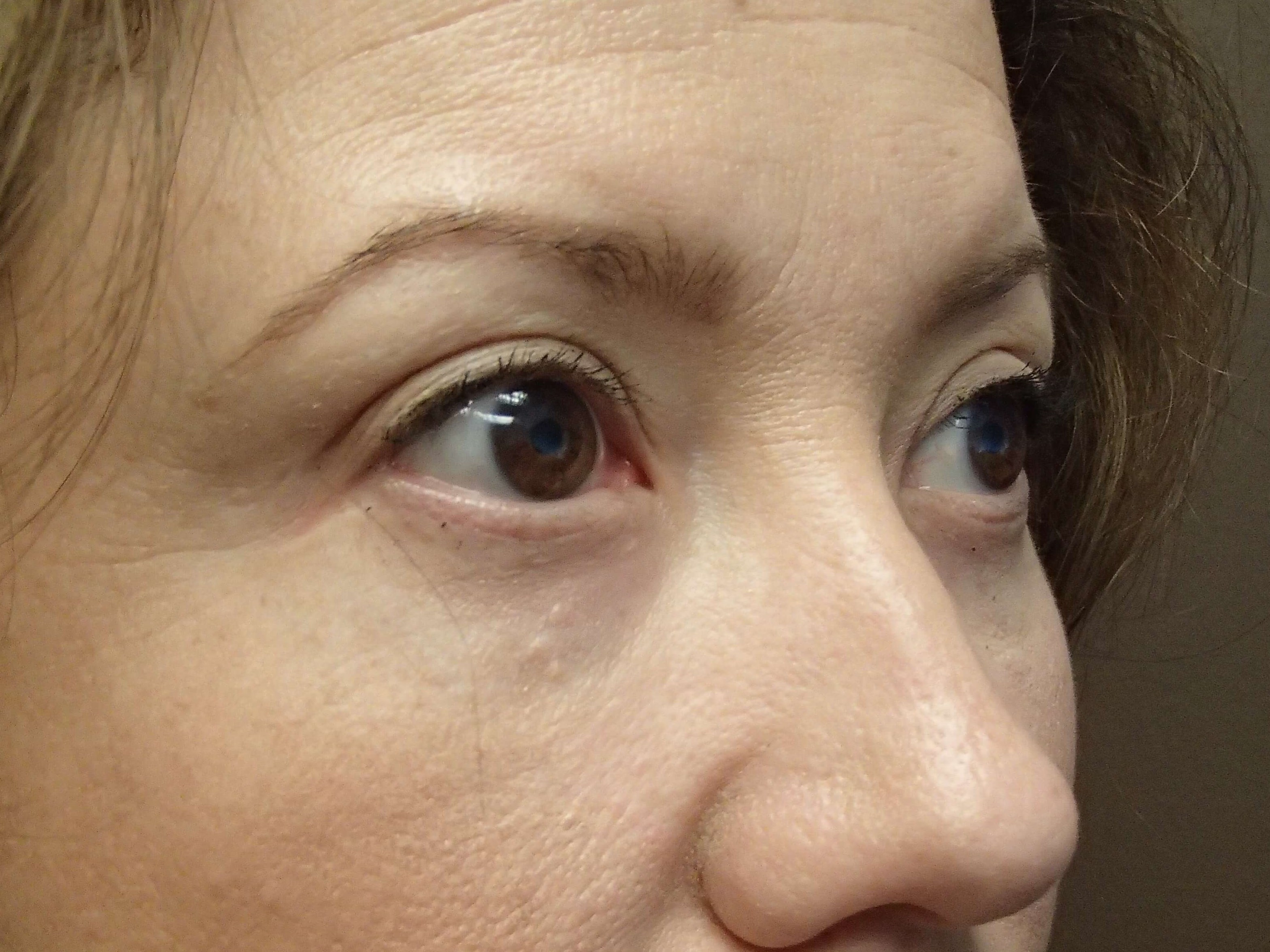 Blepharoplasty After