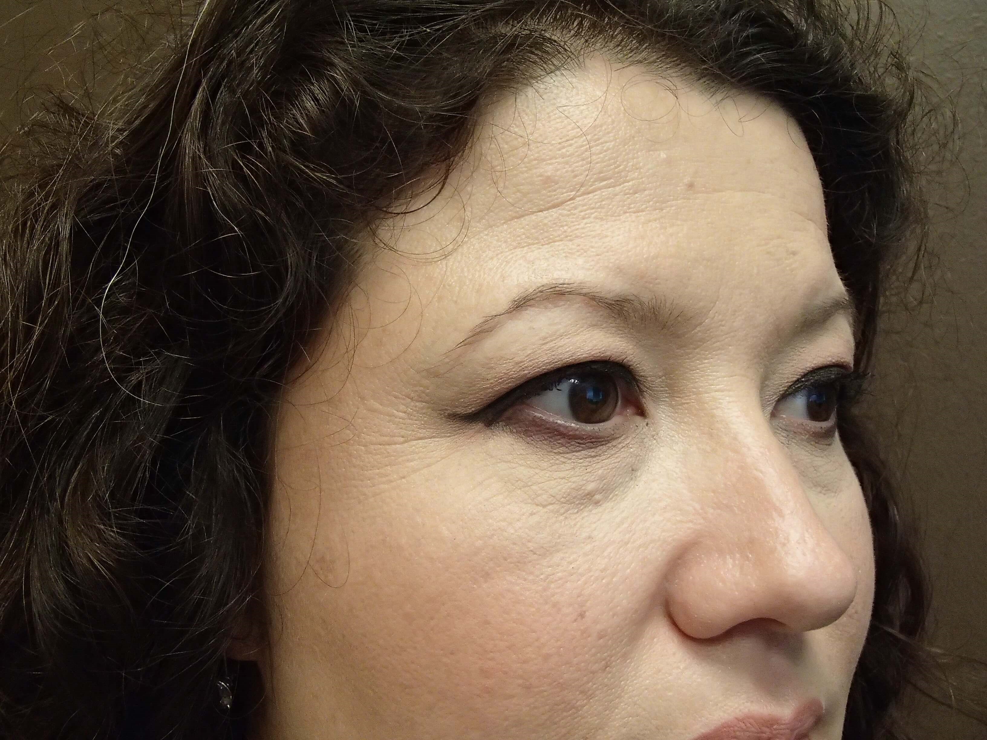 Blepharoplasty Before