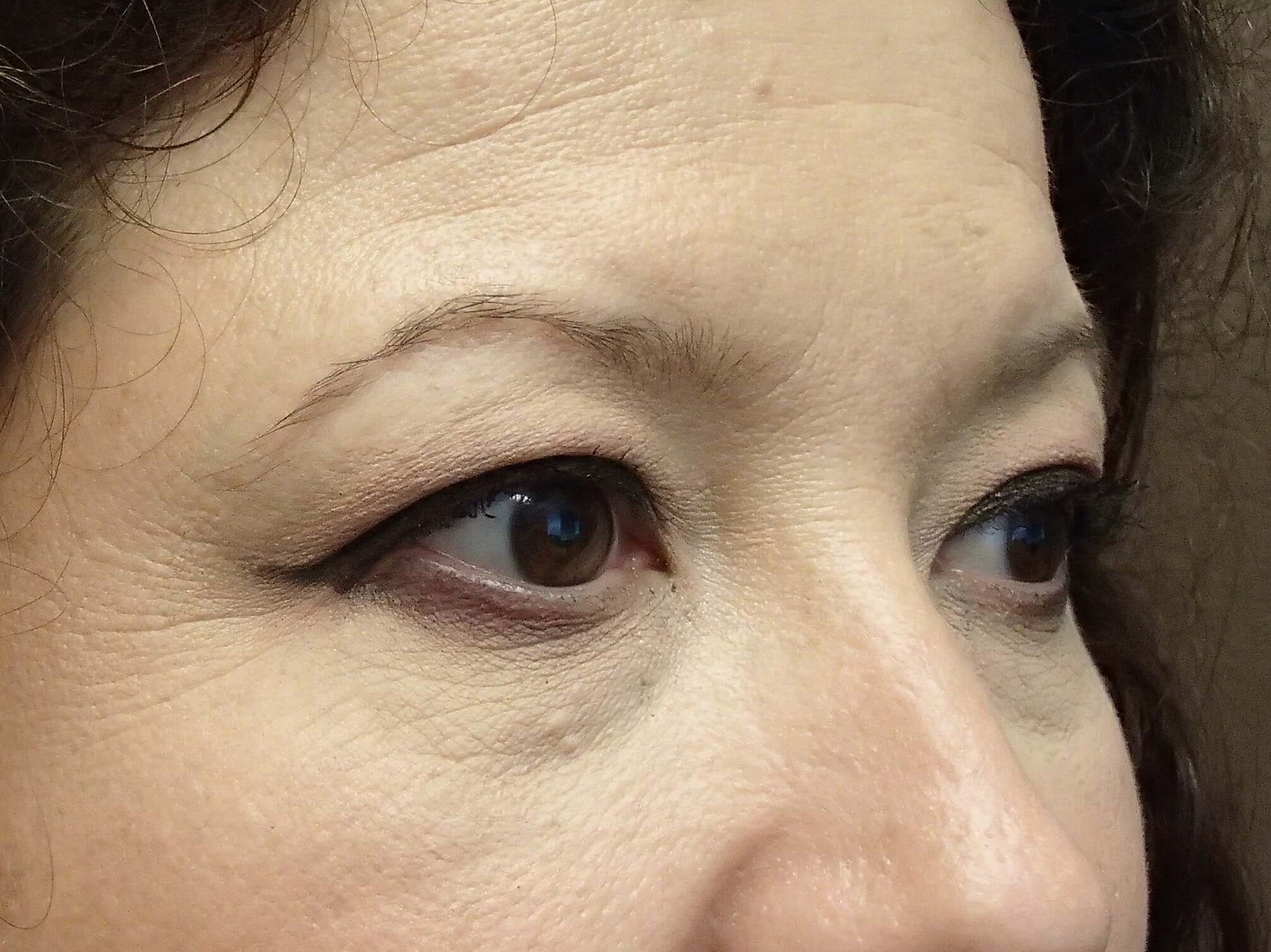 Blepharoplasty Before