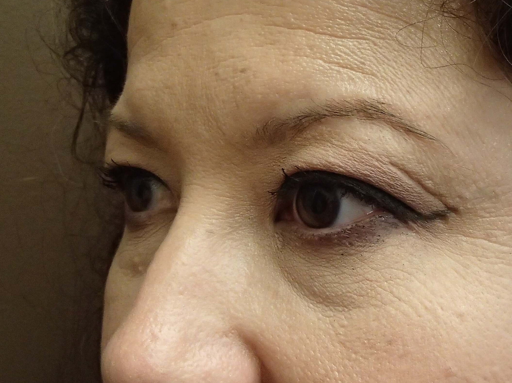 Blepharoplasty Before