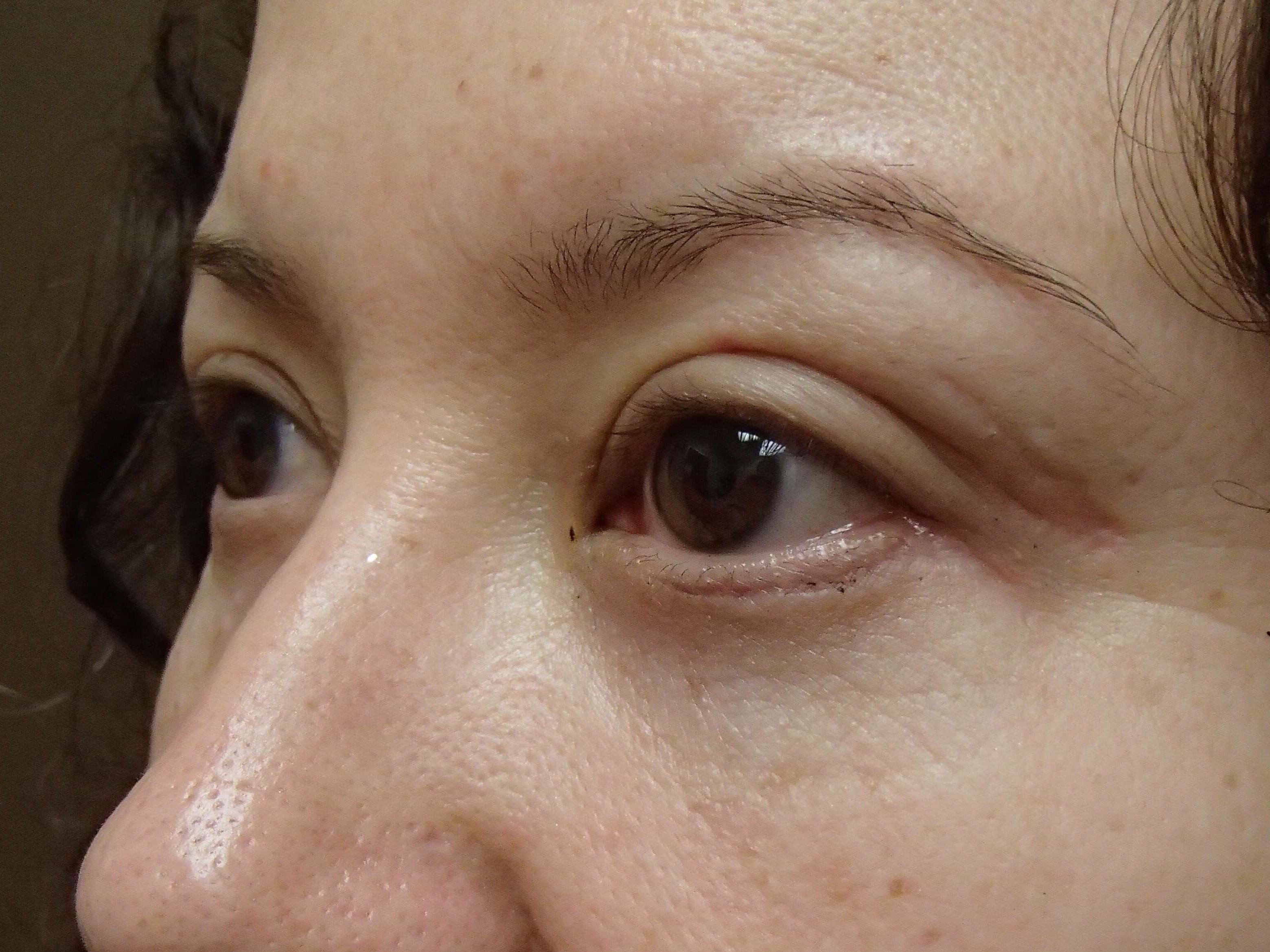Blepharoplasty After