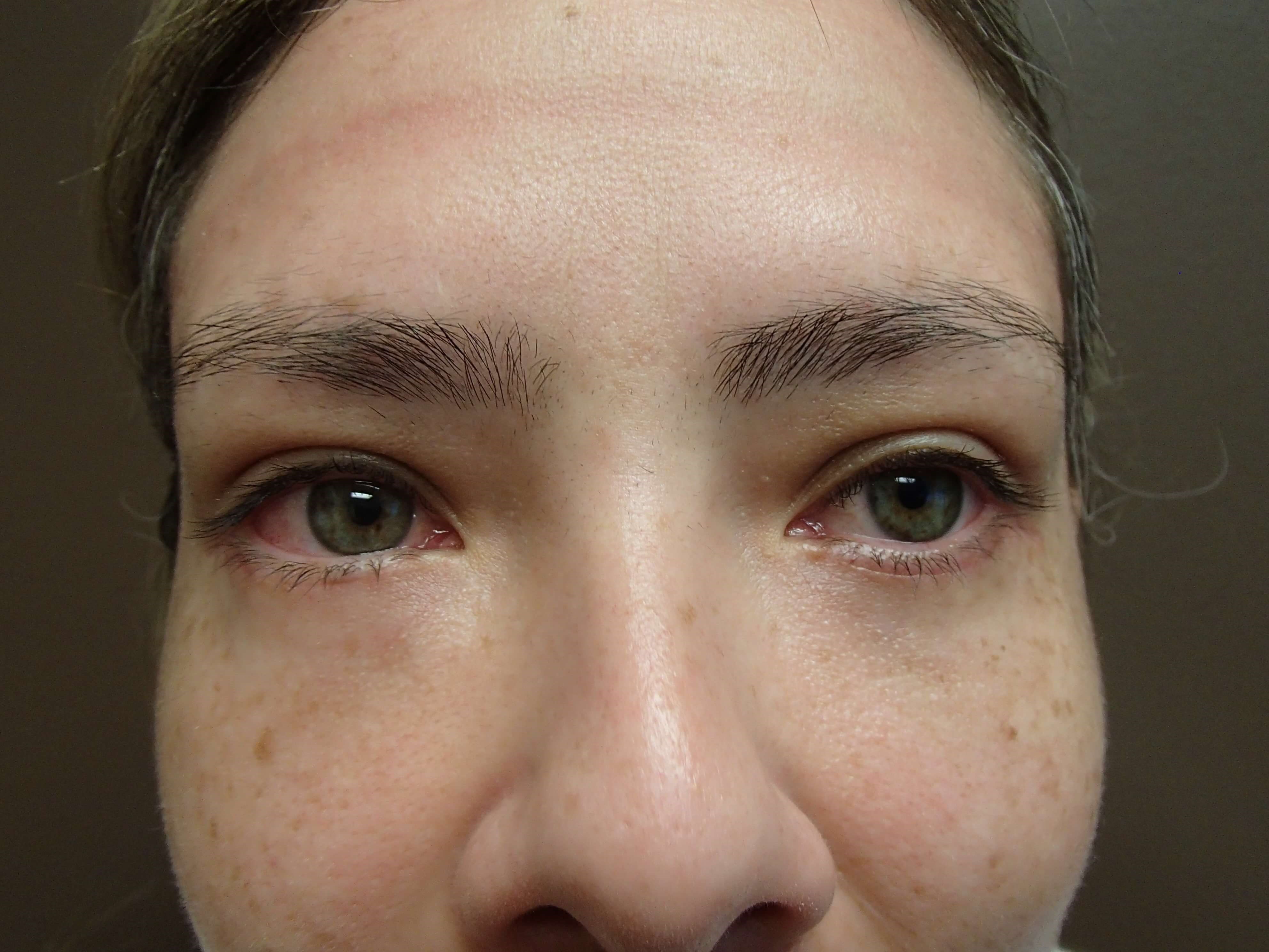 Blepharoplasty After