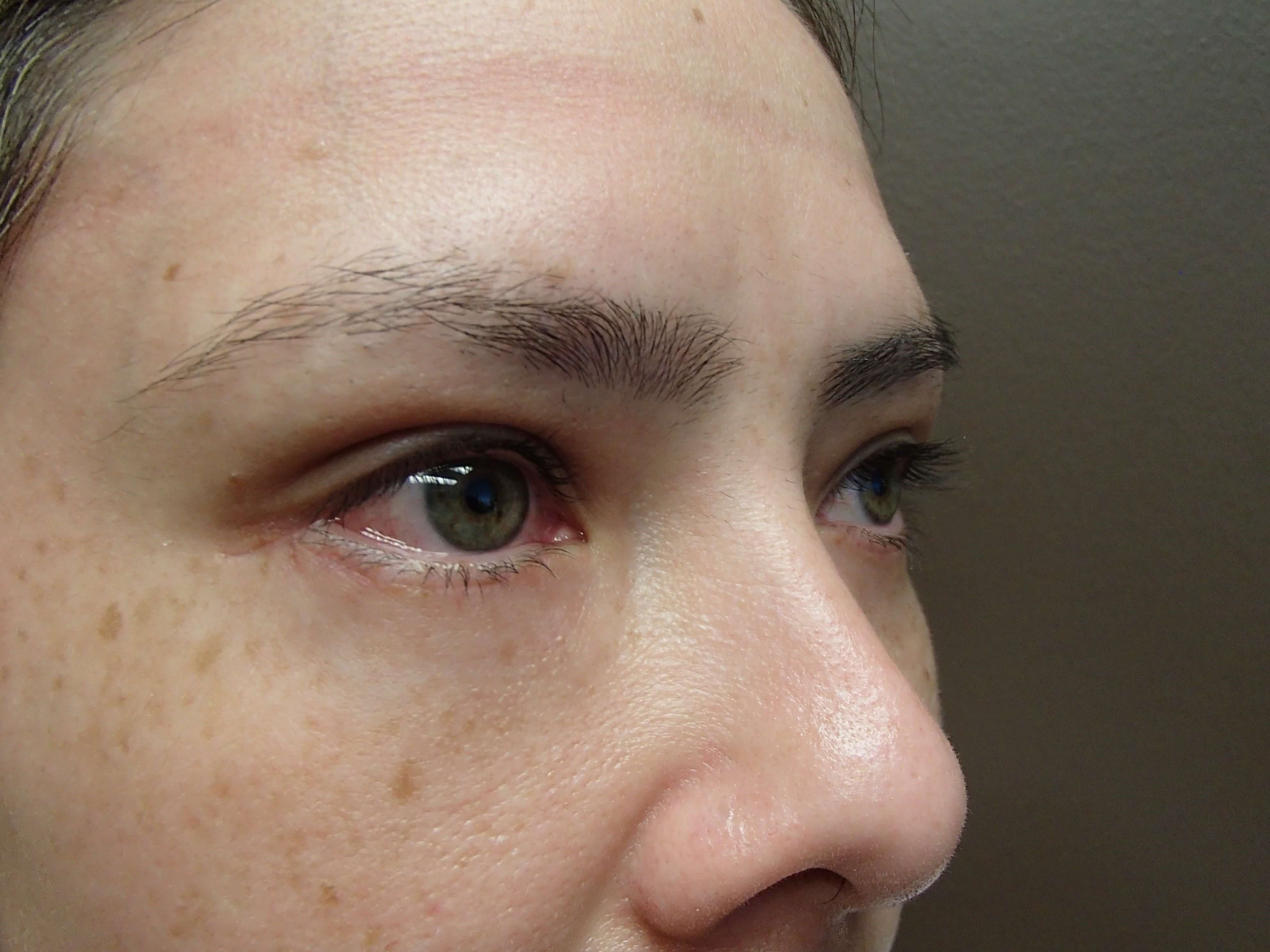 Blepharoplasty After