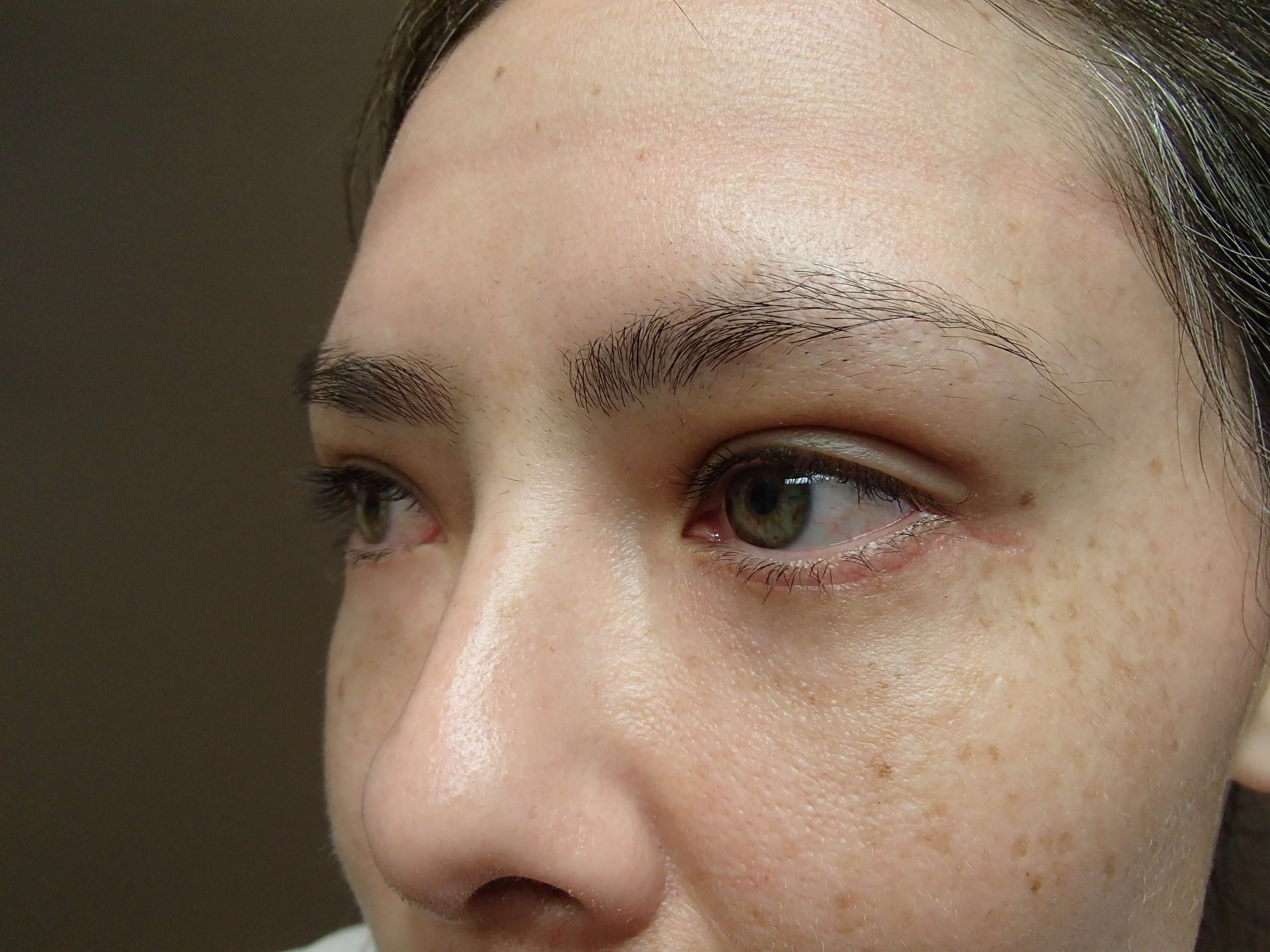 Blepharoplasty After