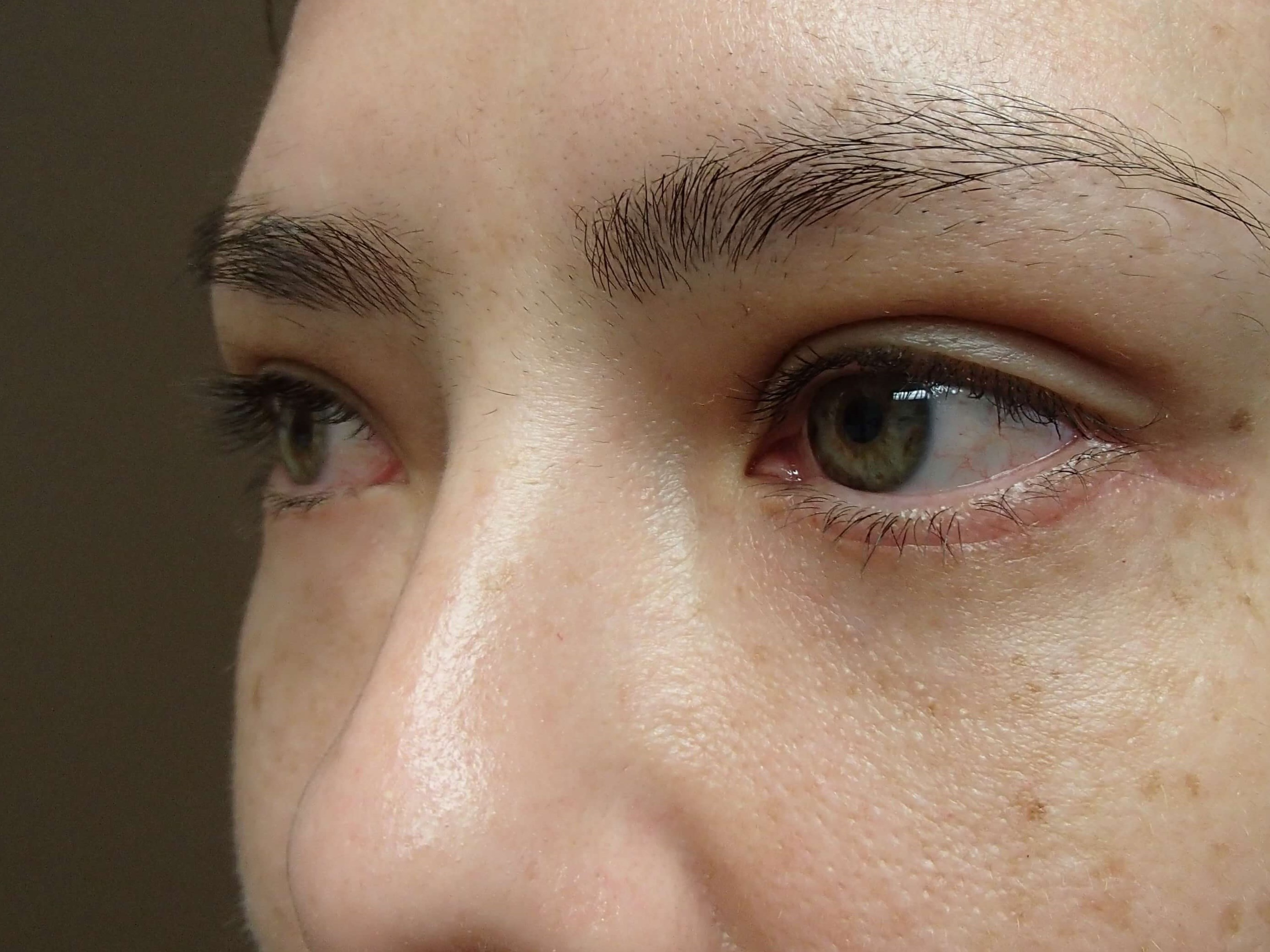 Blepharoplasty After