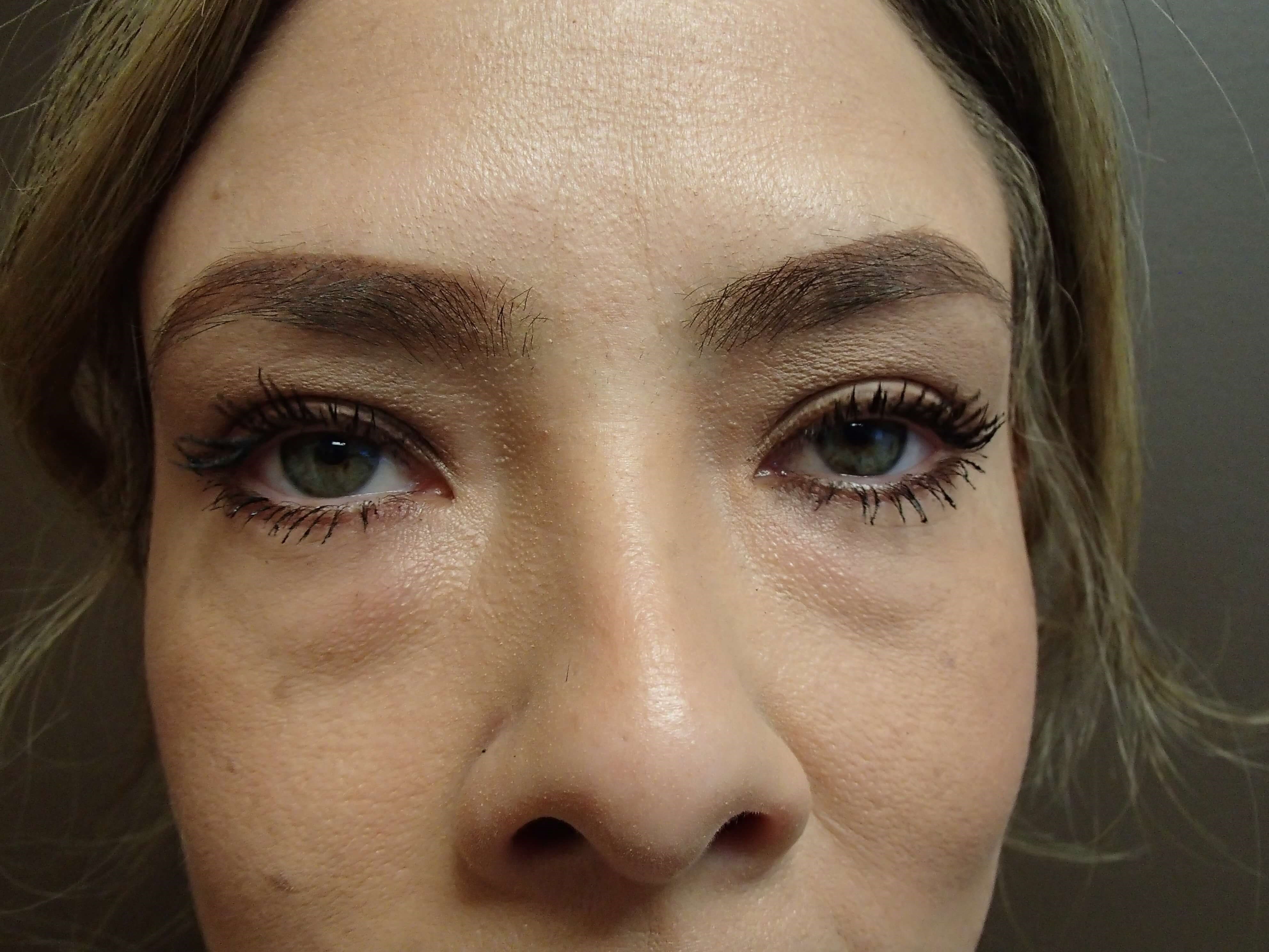 Blepharoplasty Before