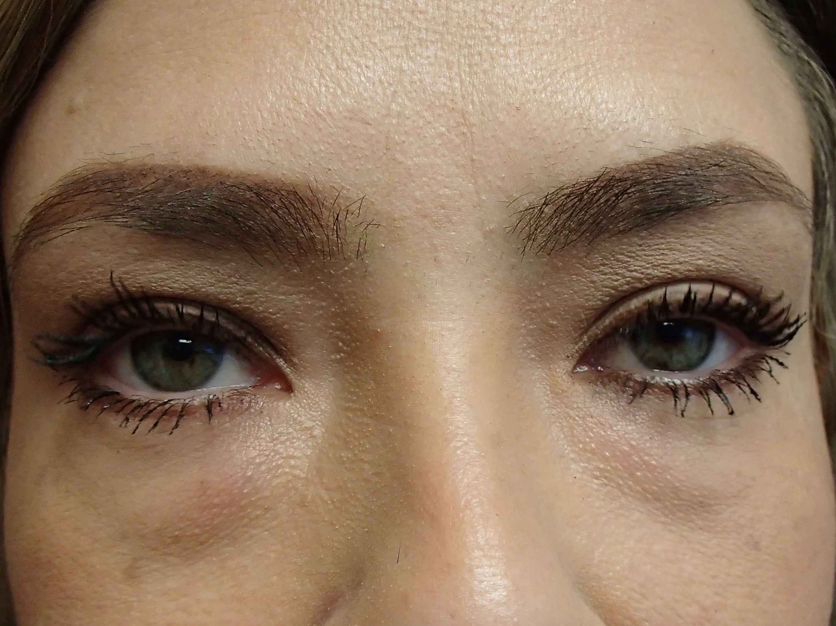 Blepharoplasty Before