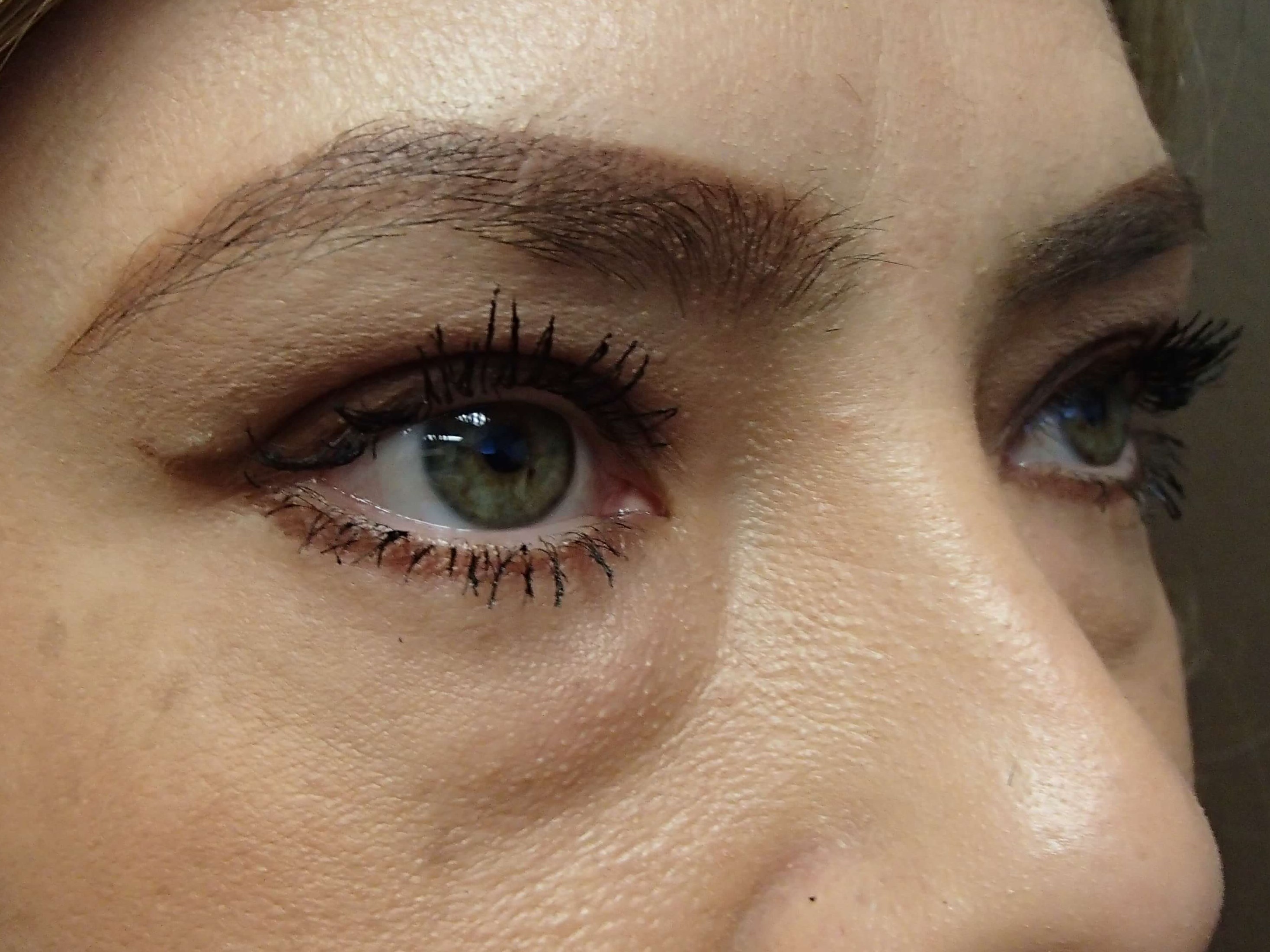 Blepharoplasty Before