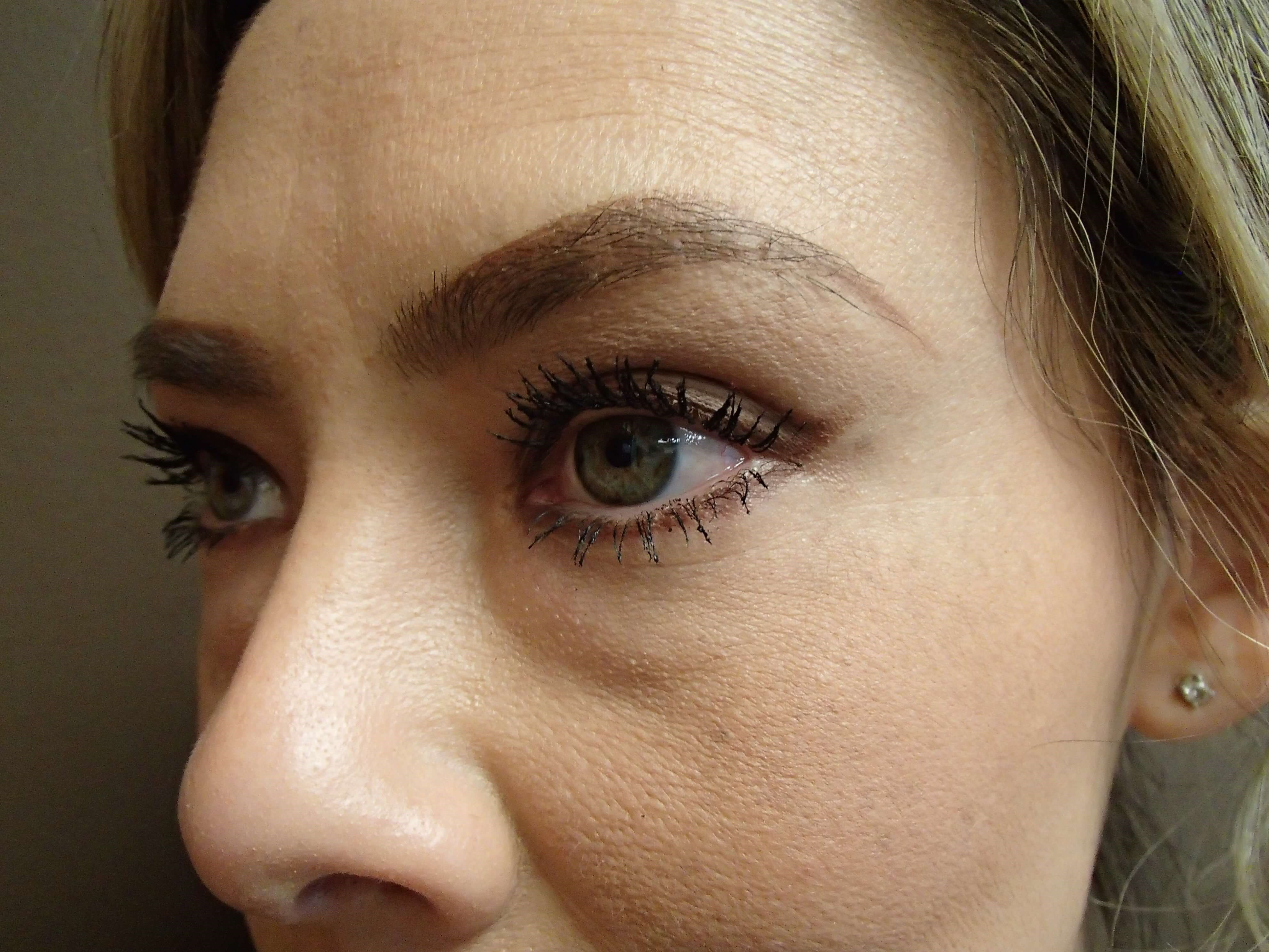 Blepharoplasty Before
