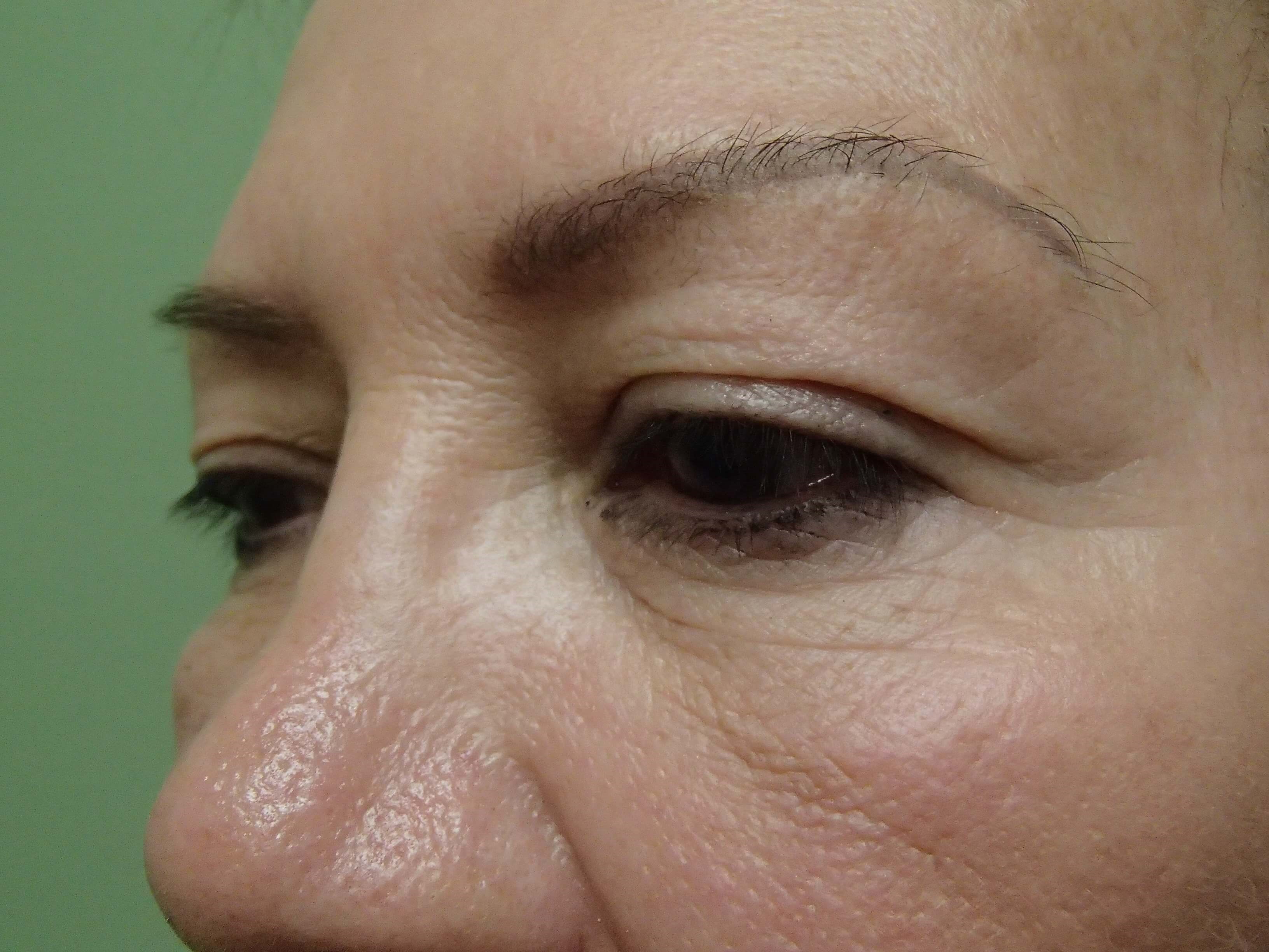 Blepharoplasty Before