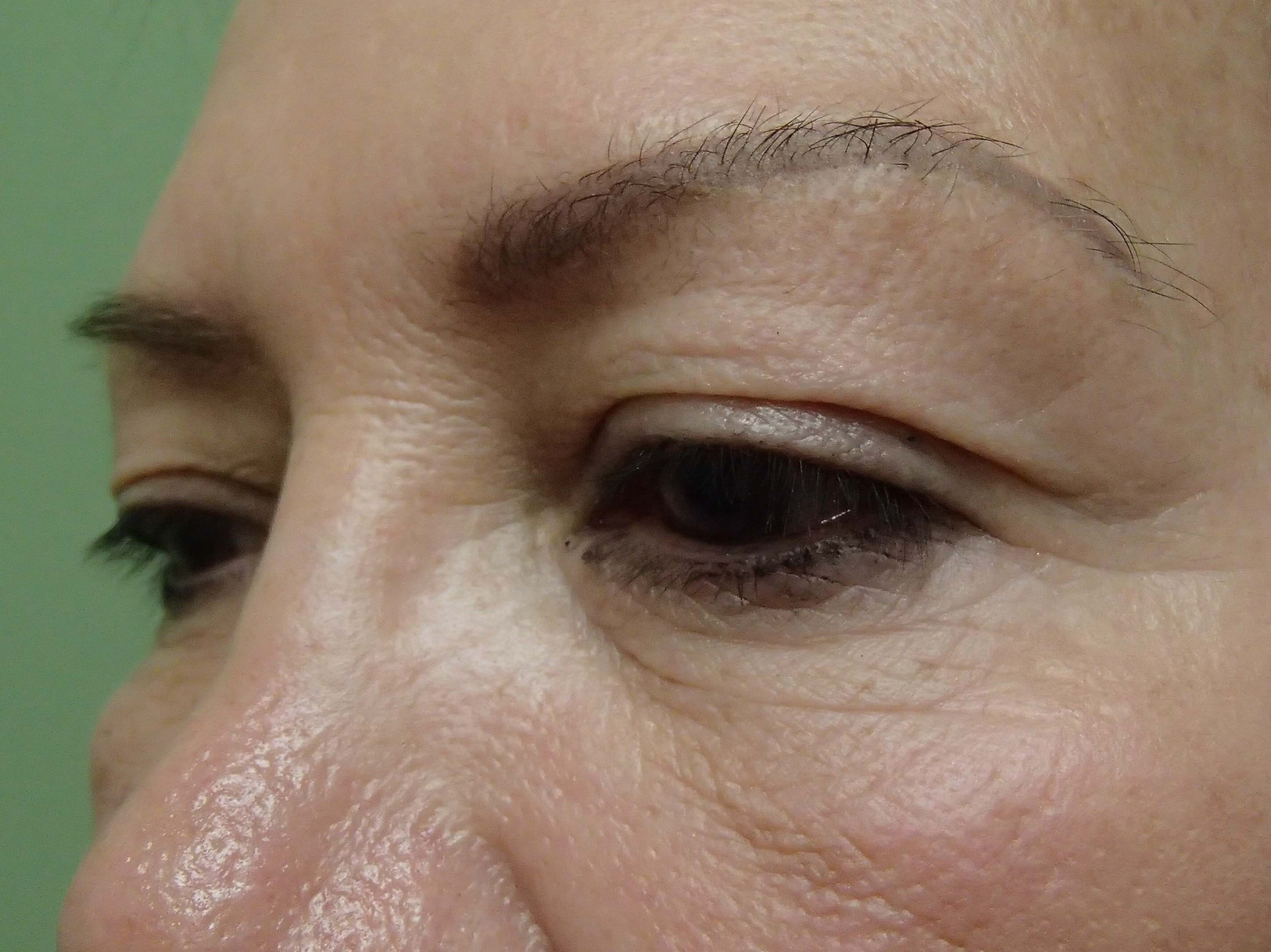 Blepharoplasty Before