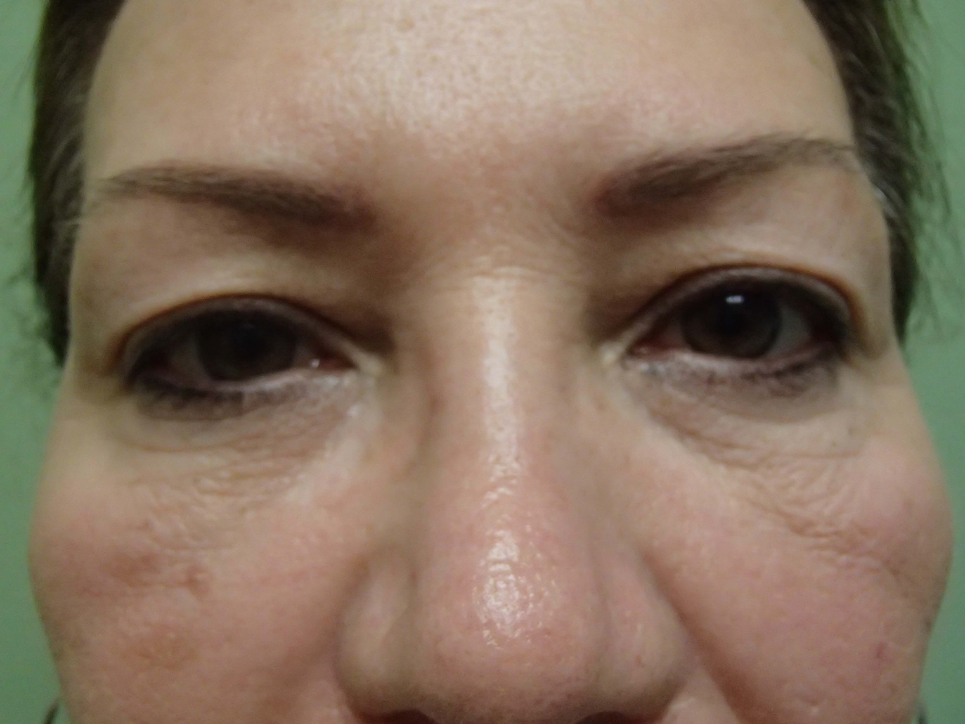 Blepharoplasty Before