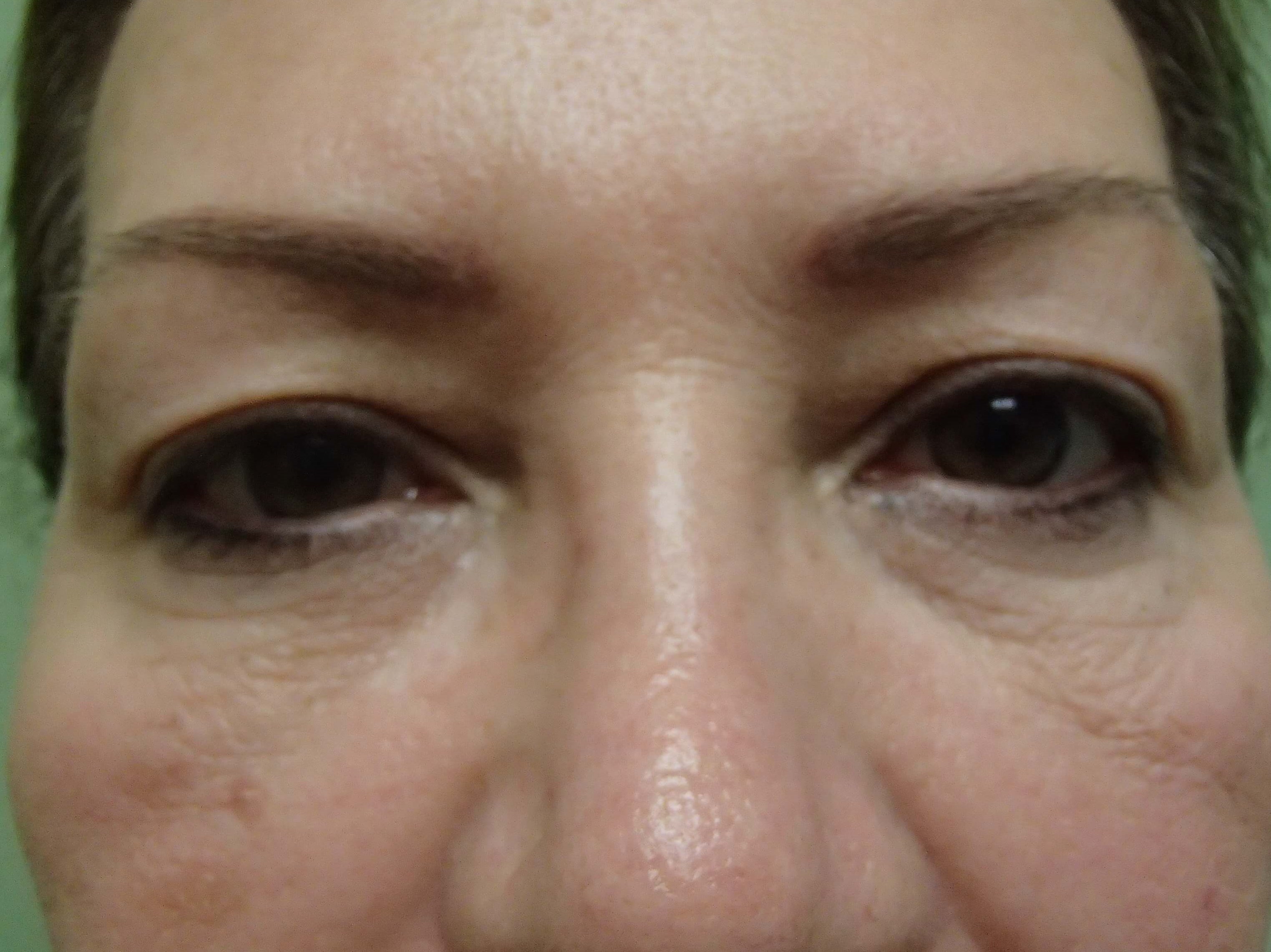 Blepharoplasty Before