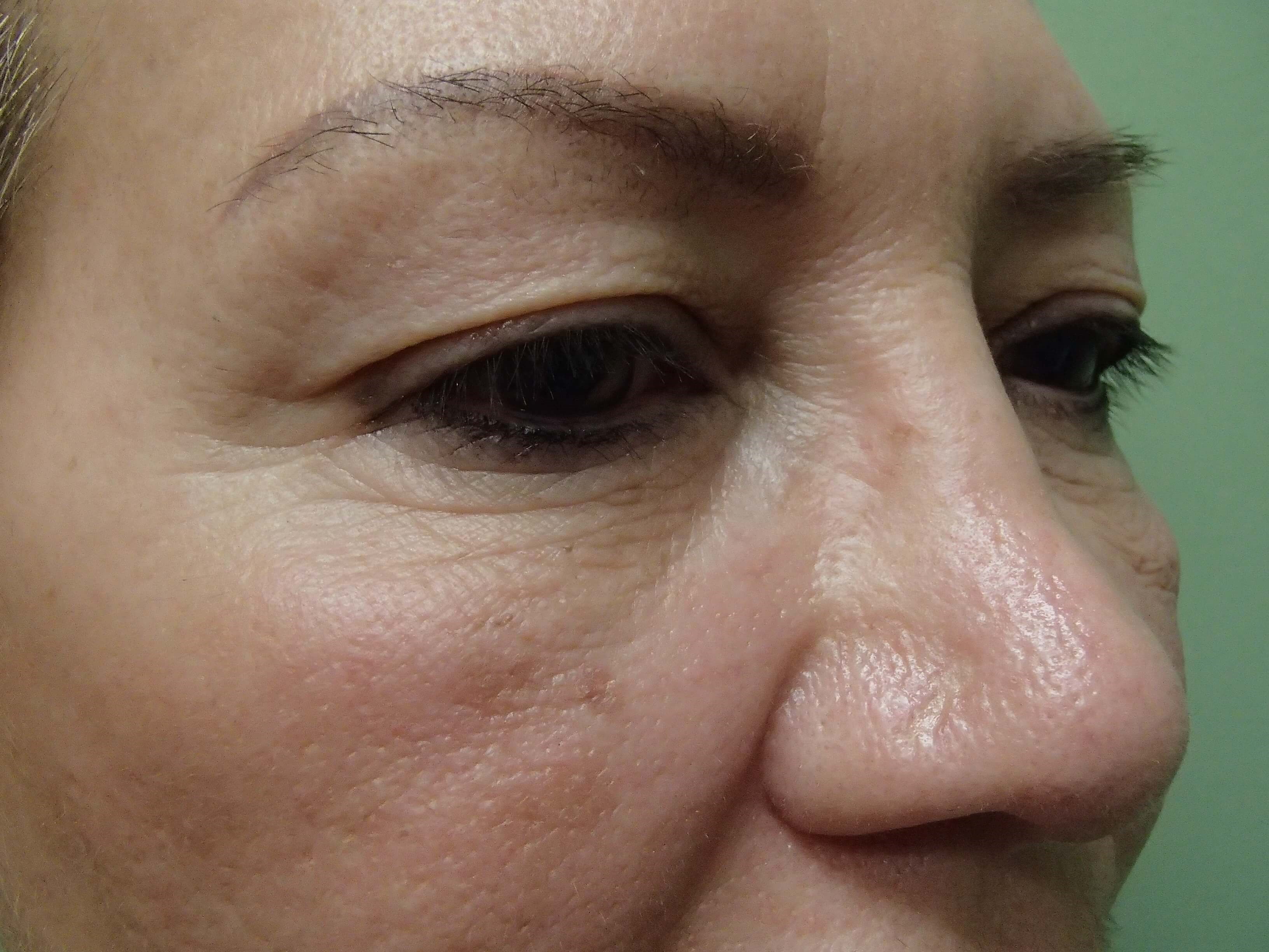 Blepharoplasty Before