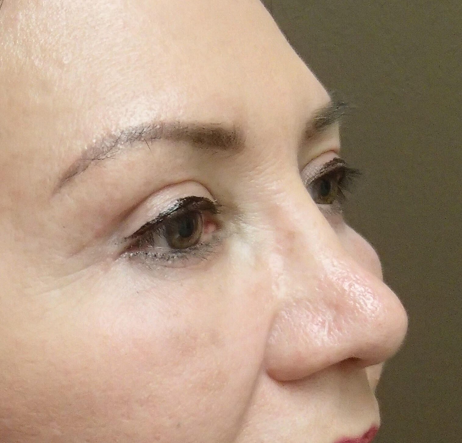 Blepharoplasty After