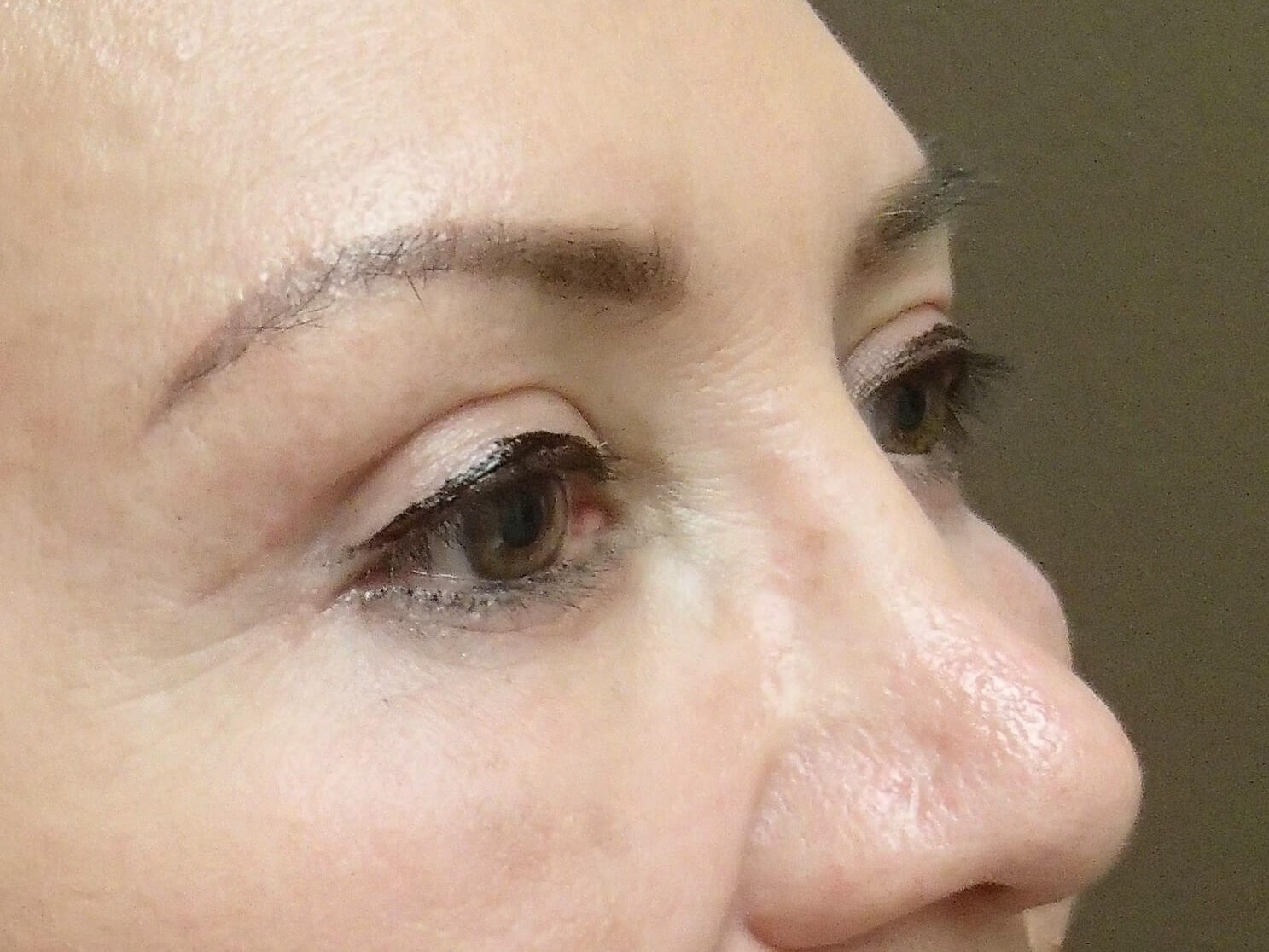 Blepharoplasty After