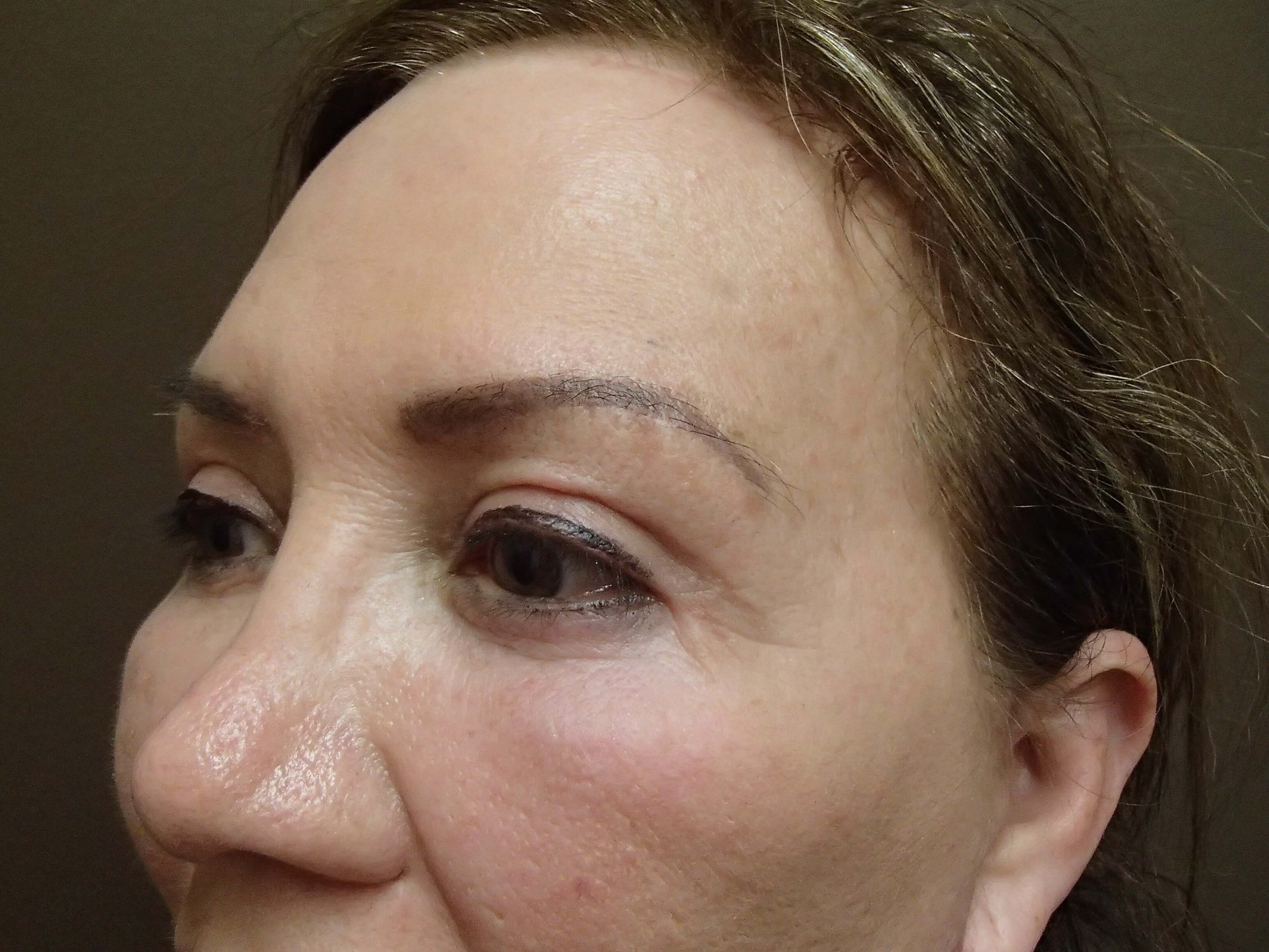 Blepharoplasty After