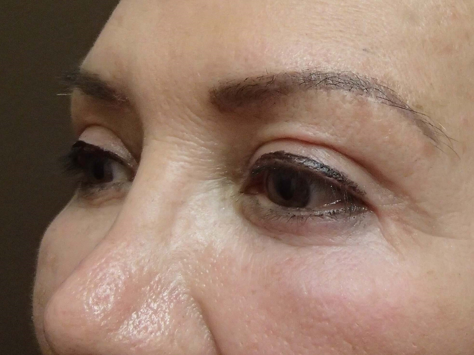Blepharoplasty After