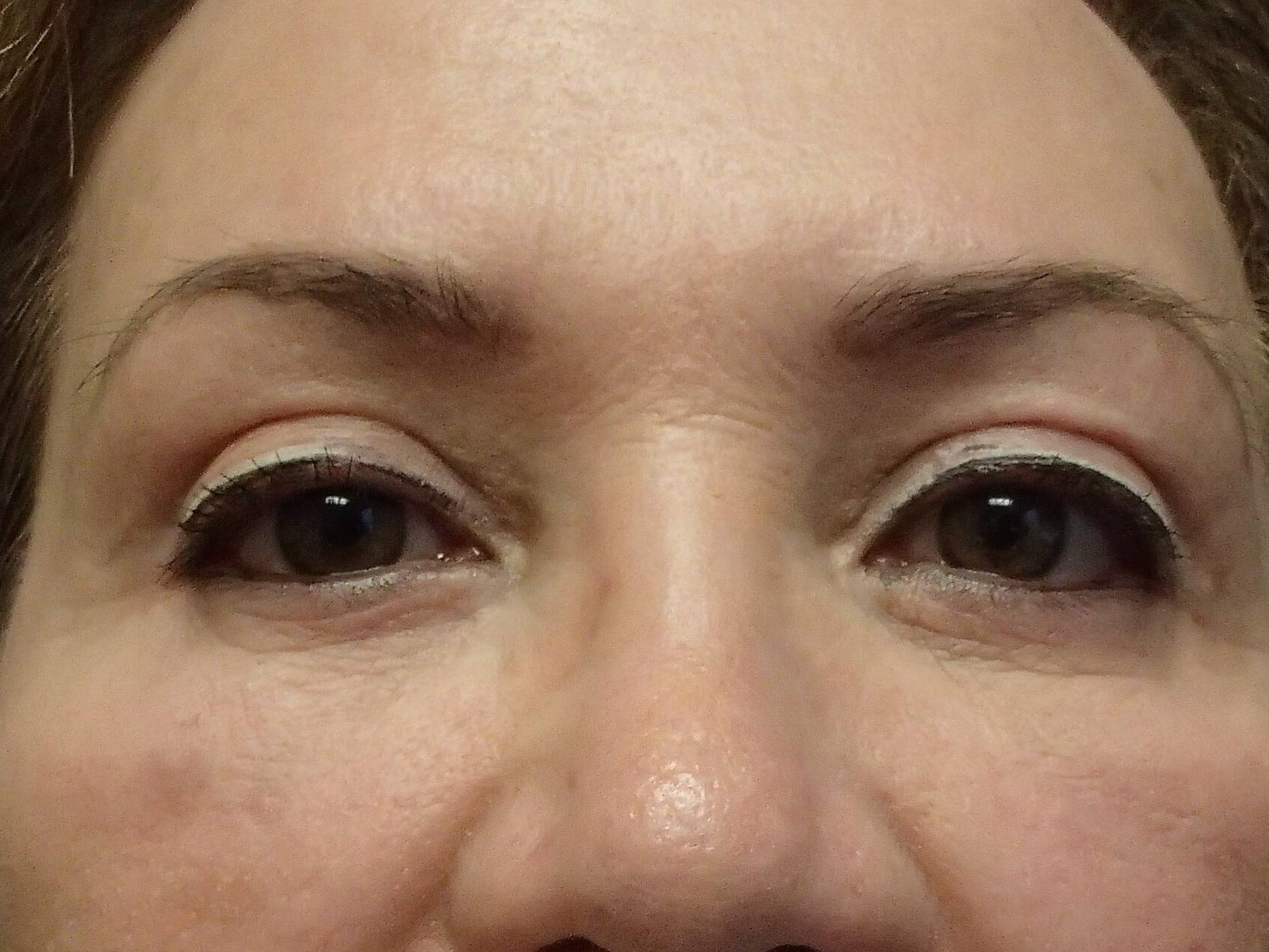 Blepharoplasty After