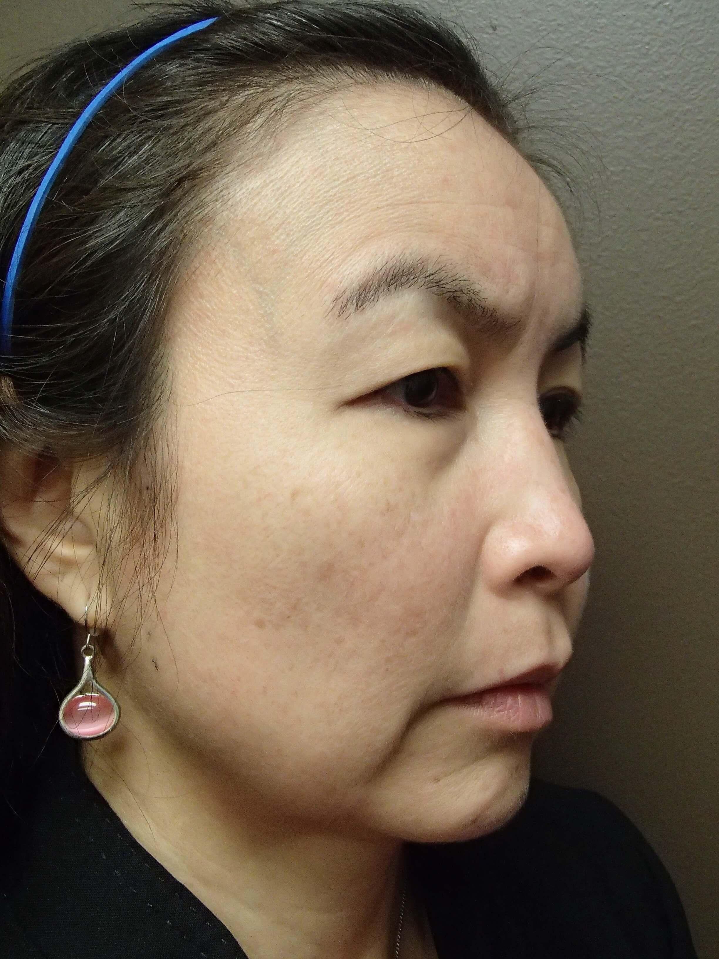 Blepharoplasty Before