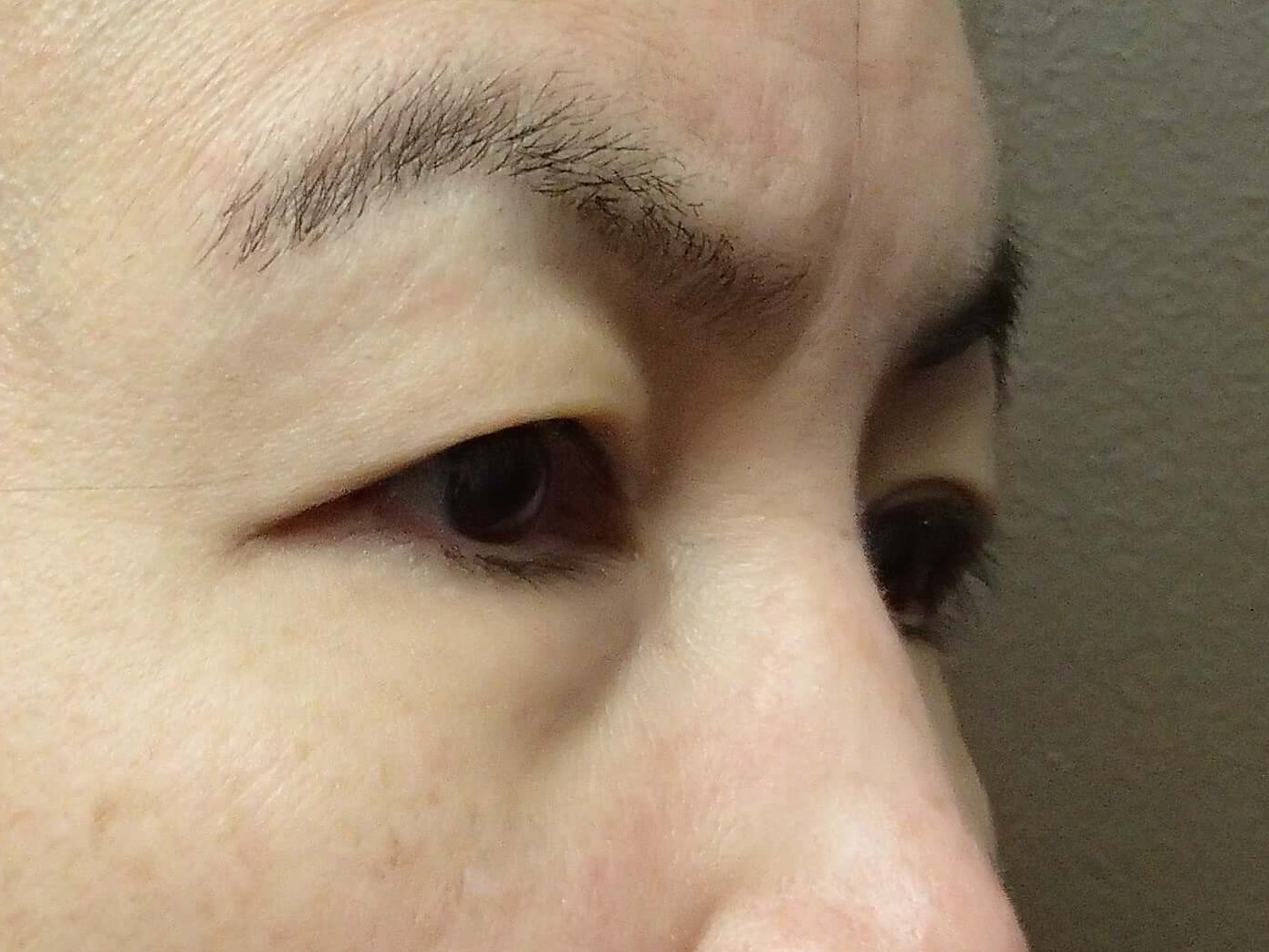 Blepharoplasty Before
