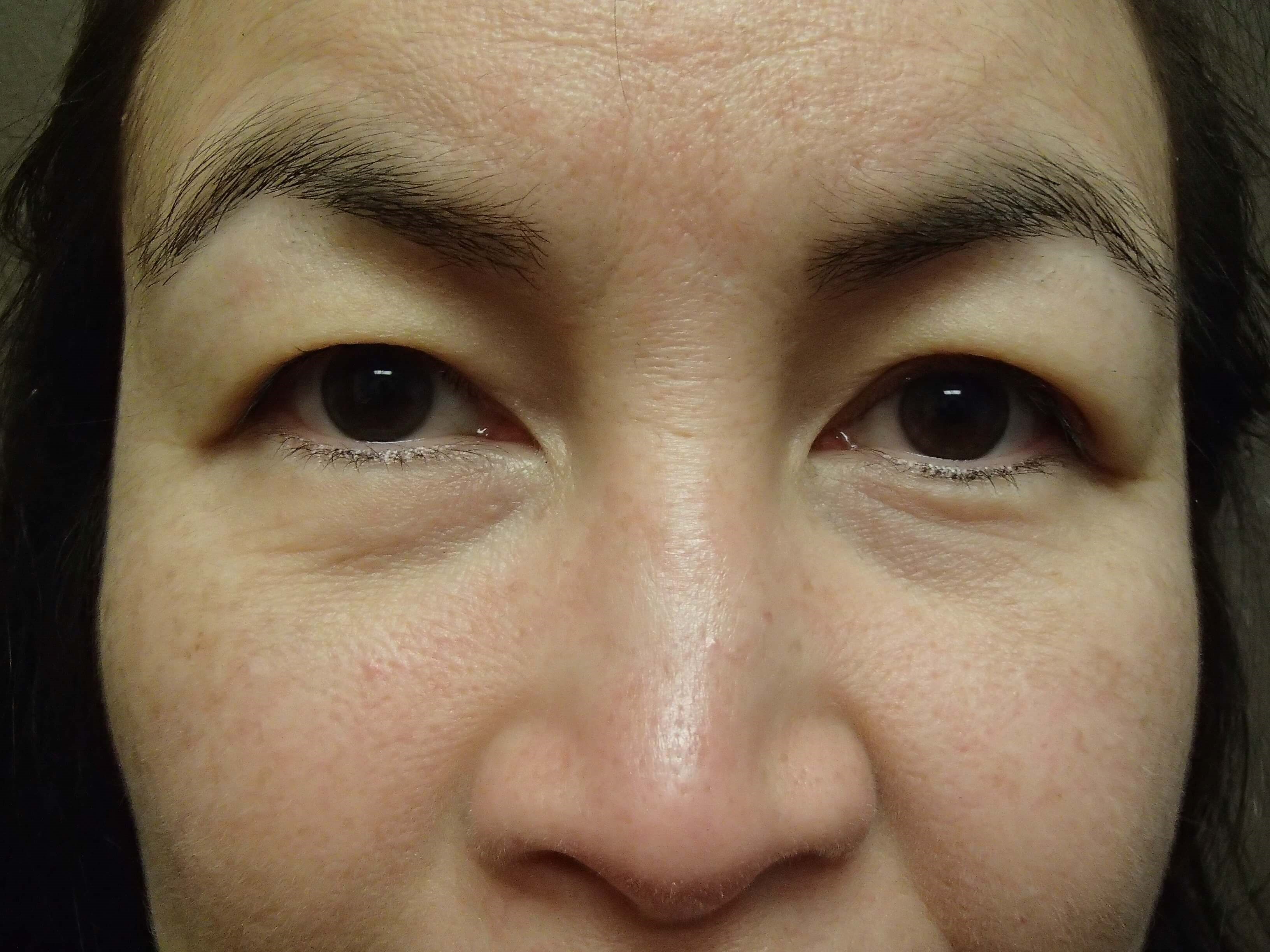 Blepharoplasty Before