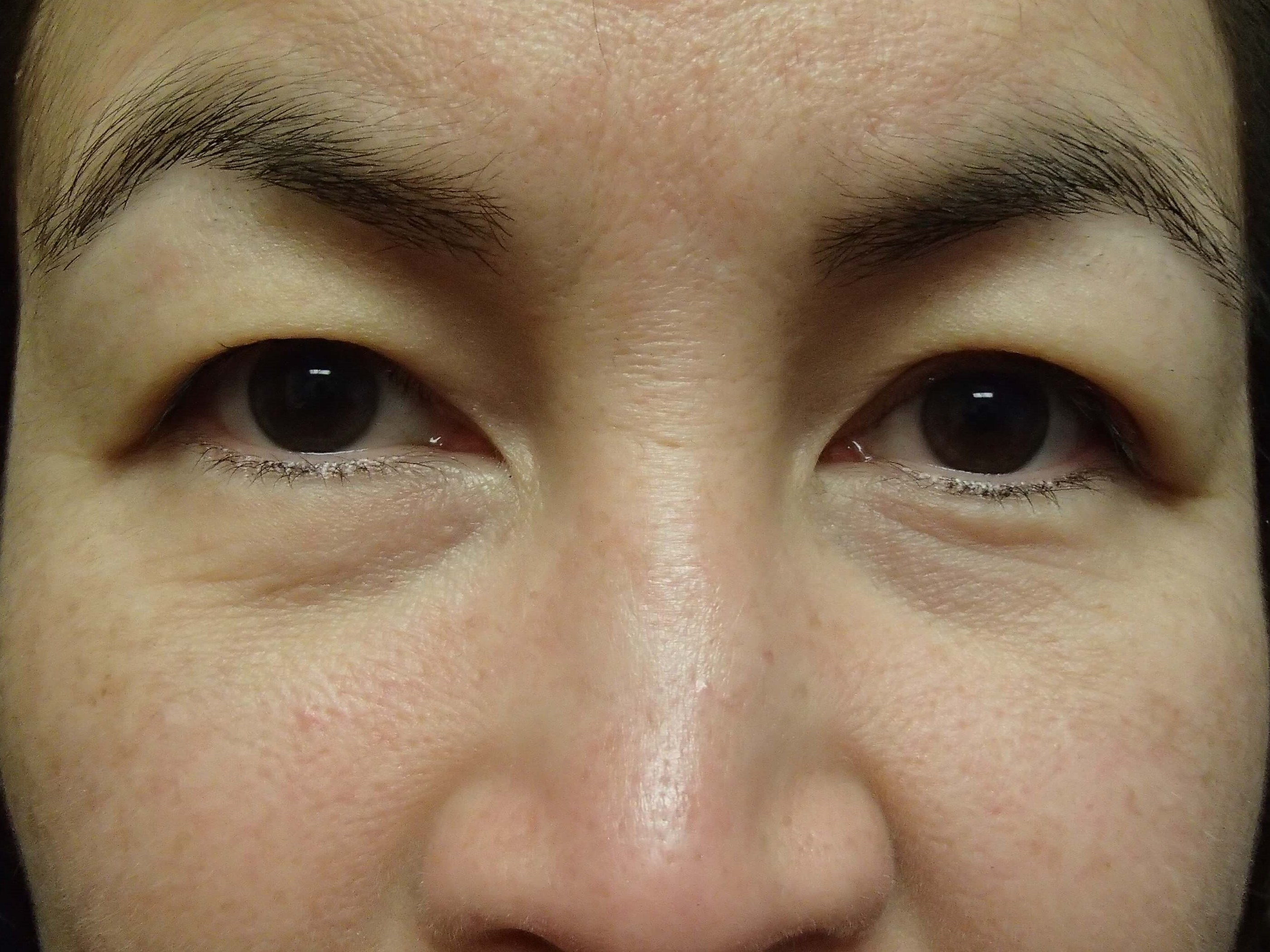 Blepharoplasty Before