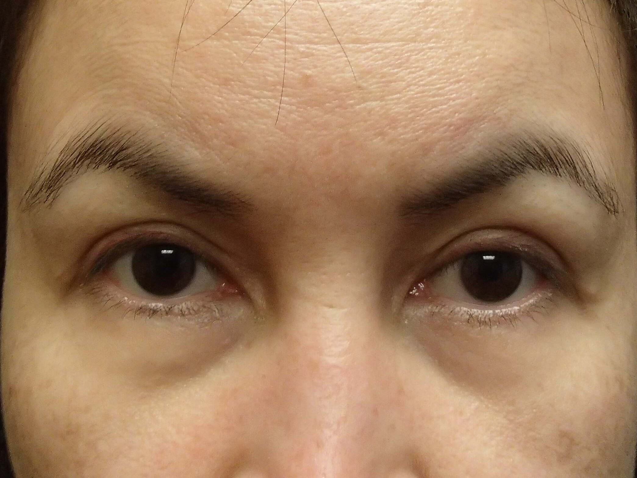 Blepharoplasty After