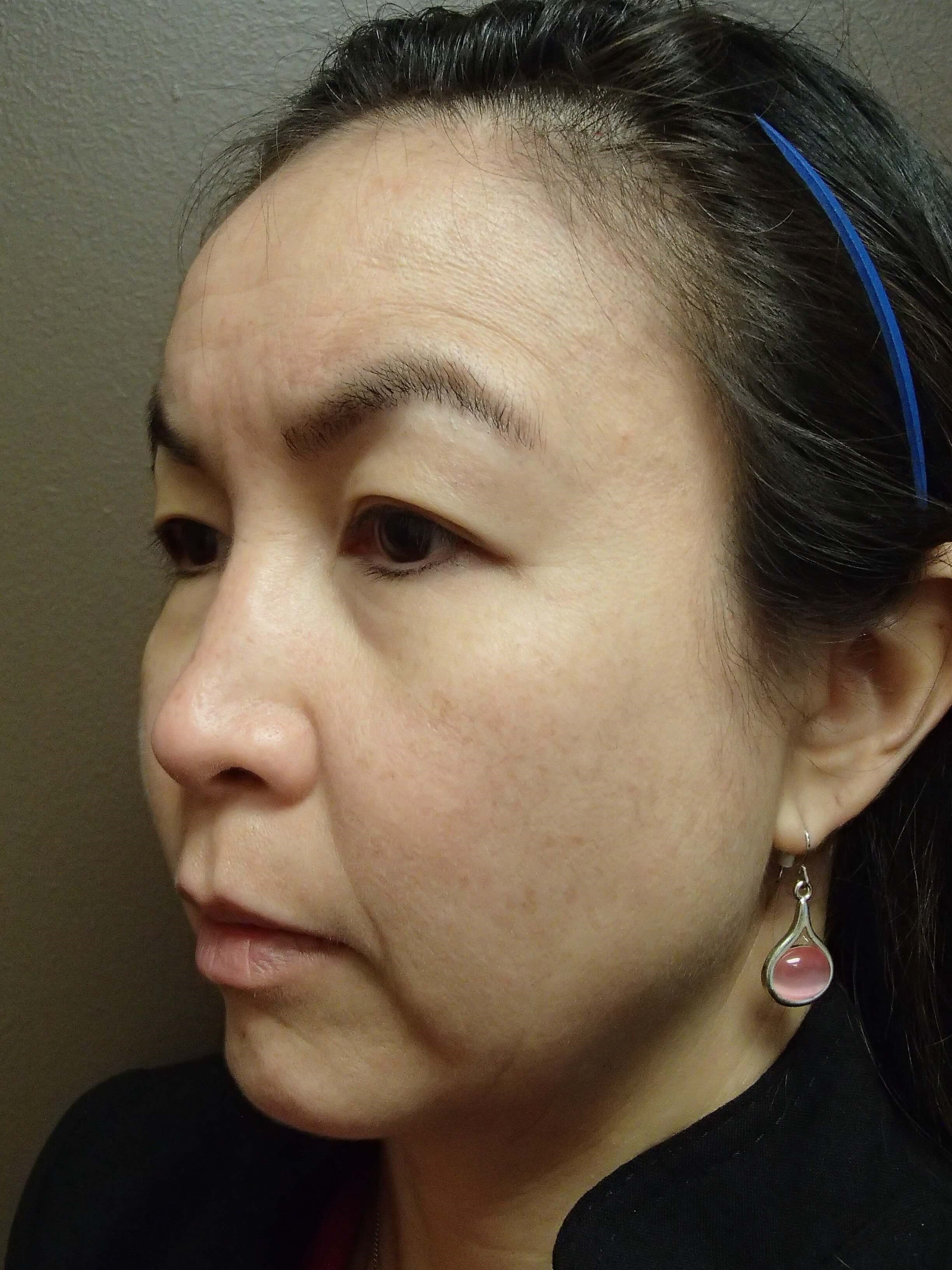 Blepharoplasty Before